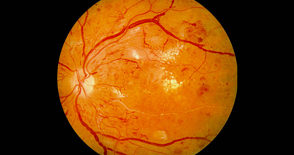 Diabetic Eye Care — Carrot Health