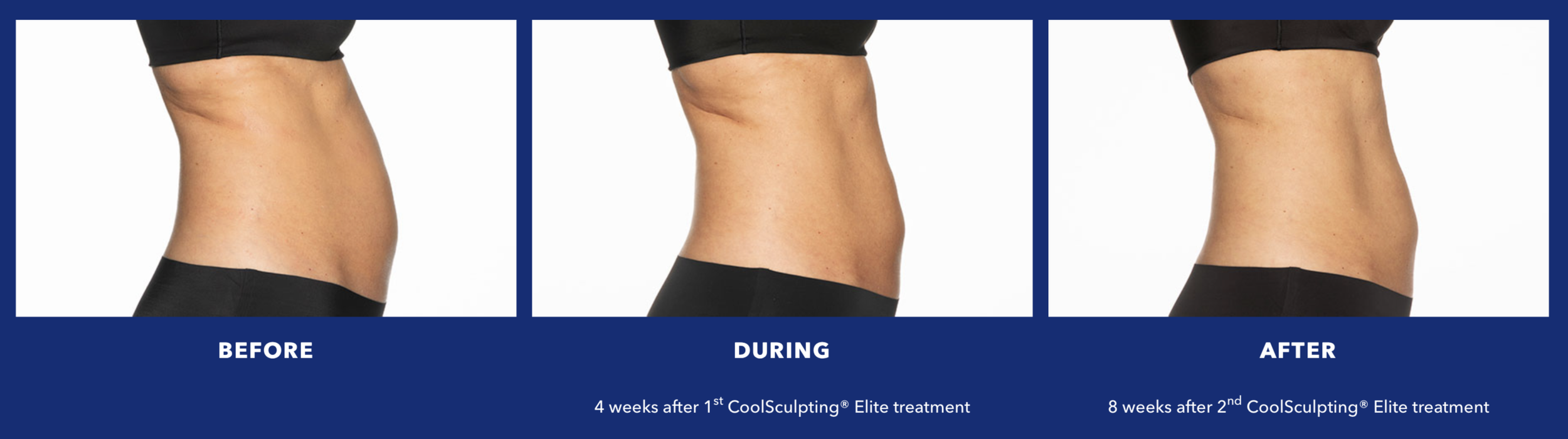 CoolSculpting Elite before, during, and after — abdomen results at 4 and 8 weeks