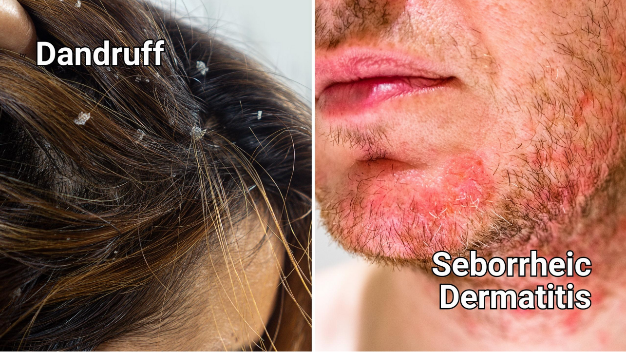 Dandruff vs Seborrheic Dermatitis