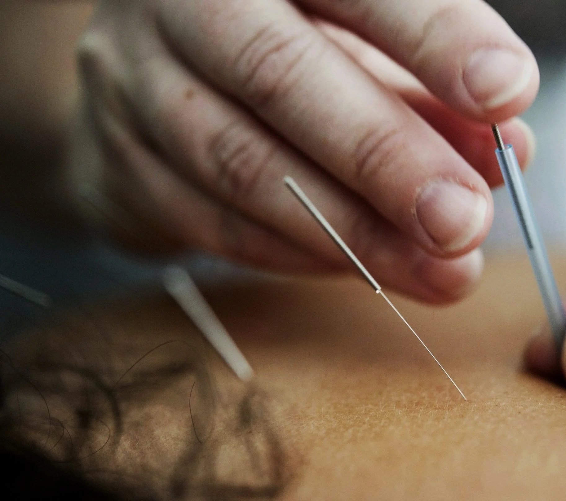 What Can Acupuncture Help With?