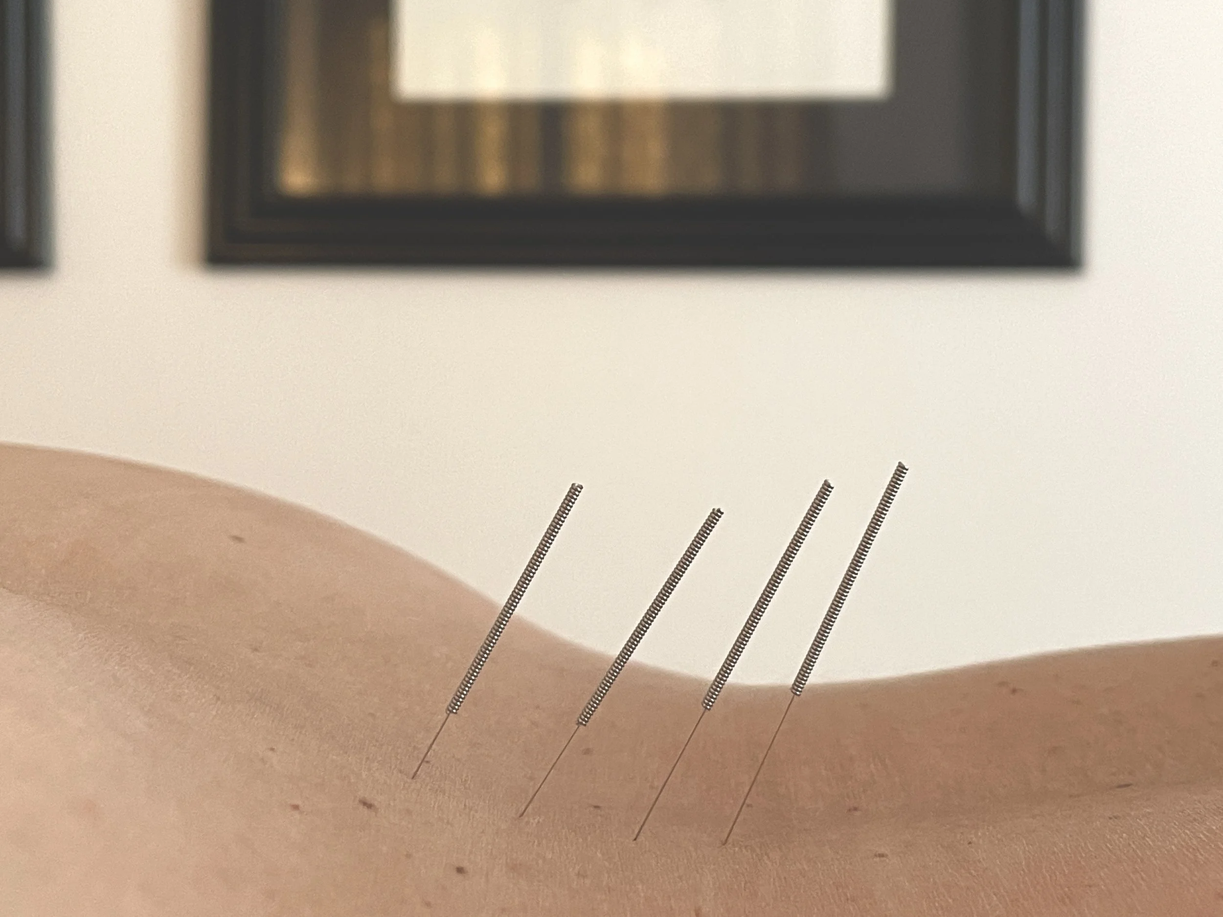 Four acupuncture needles inserted into a person's back, with framed certificates hanging on a white wall in the background.