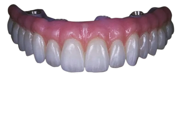 Completed all-on-four model