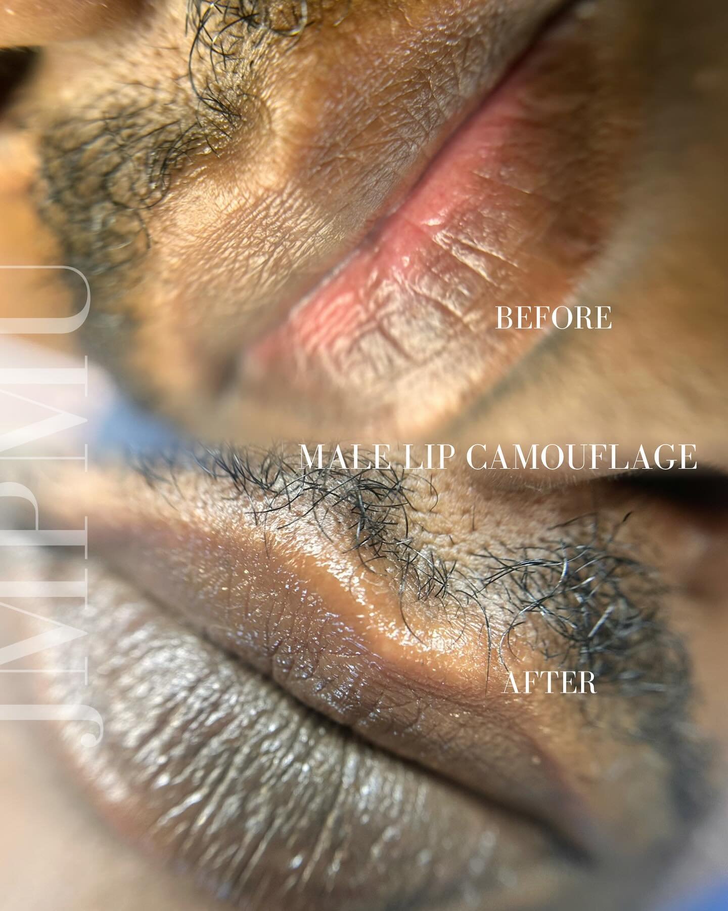 Male lip camouflage