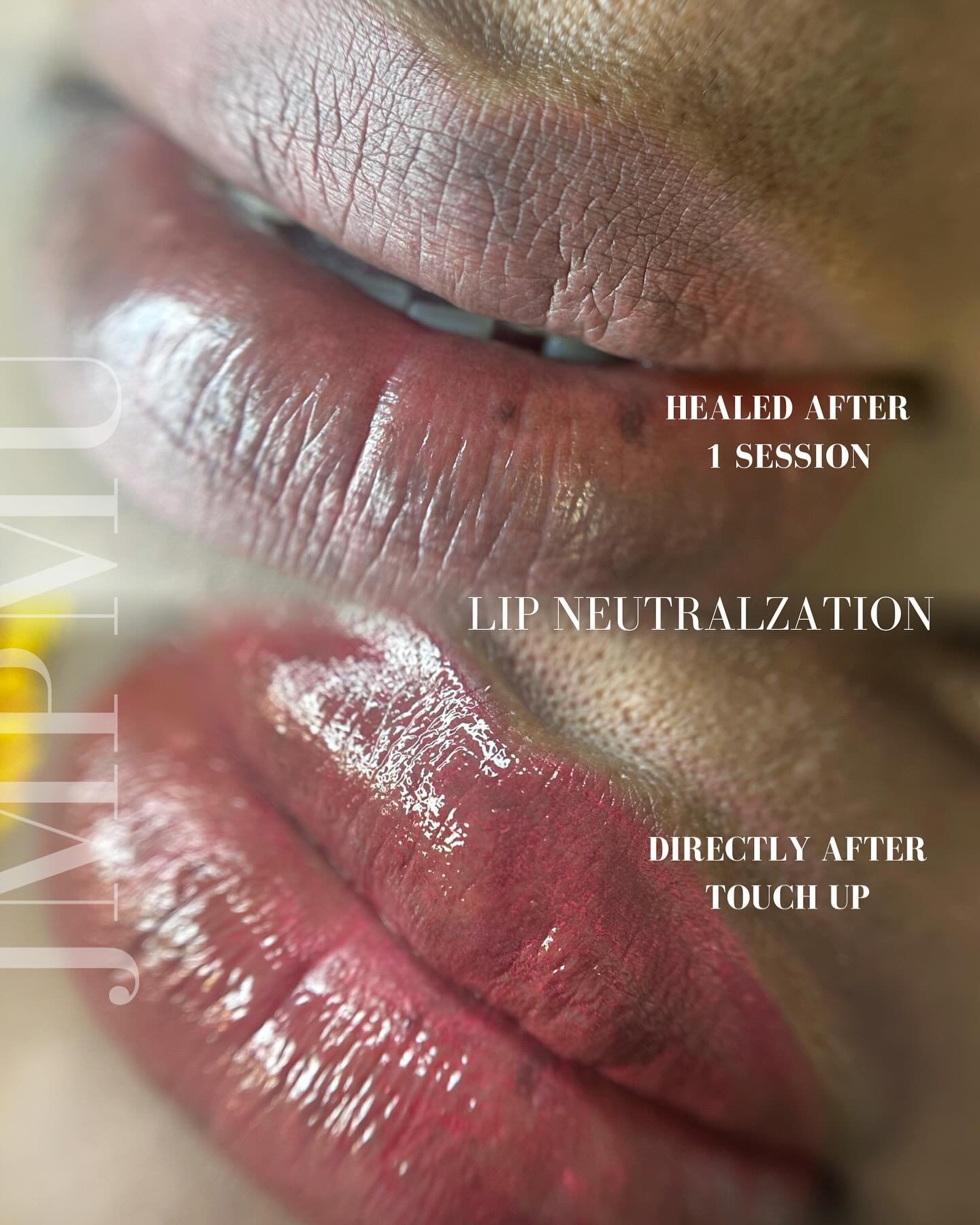 Healed lip neutralization, after just 1  and directly after her touch up session today .