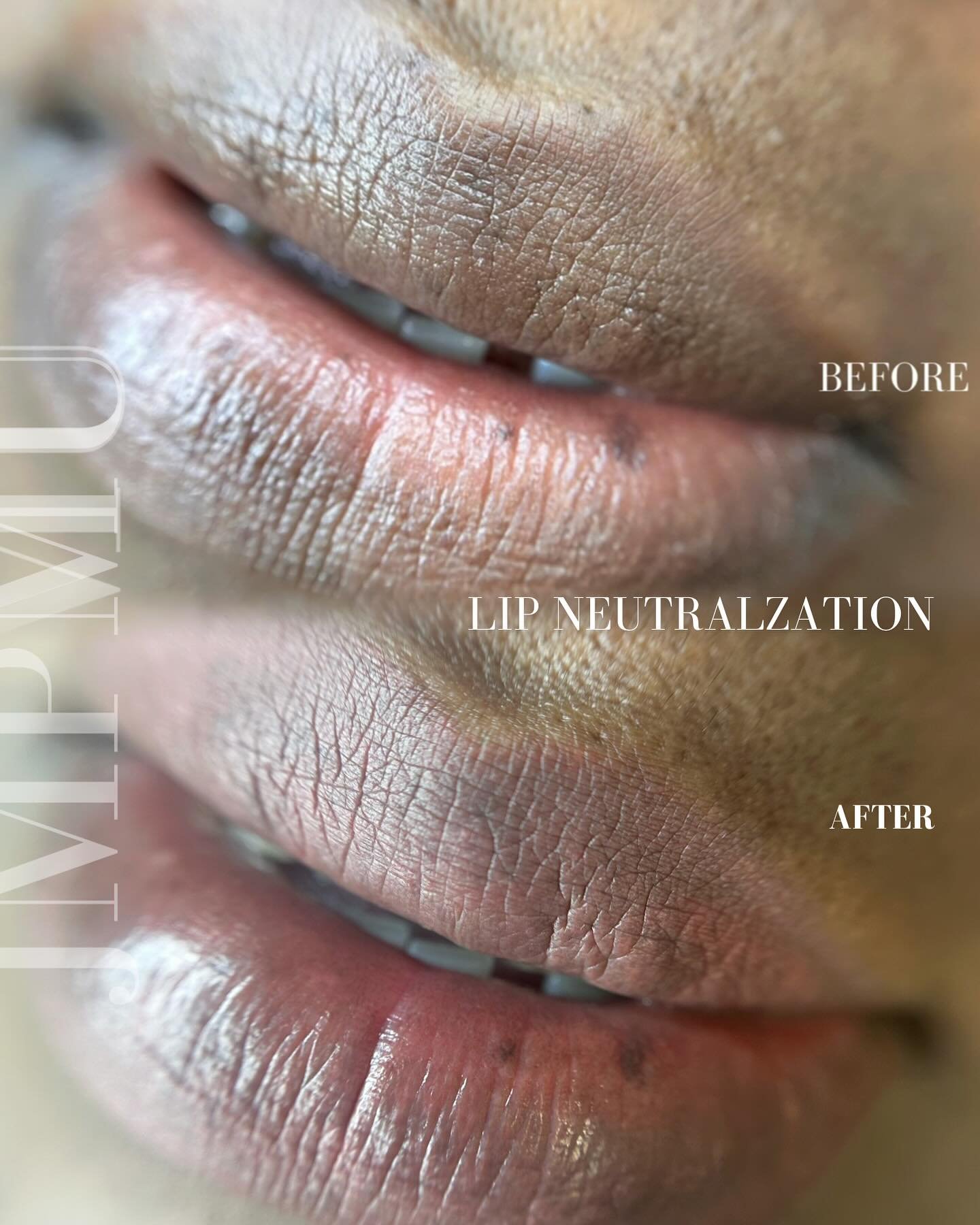 Healed lip neutralization, after just 1 session.