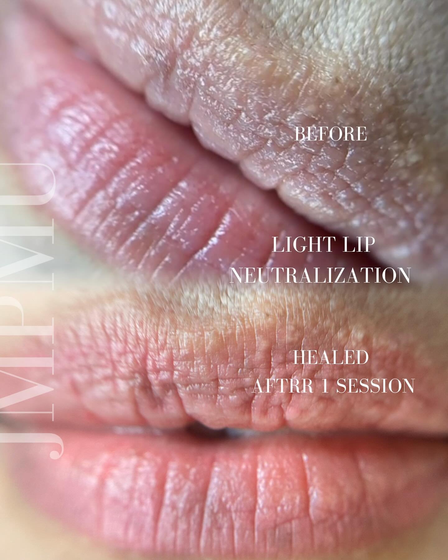 Healed , light lip neutralization. 💋