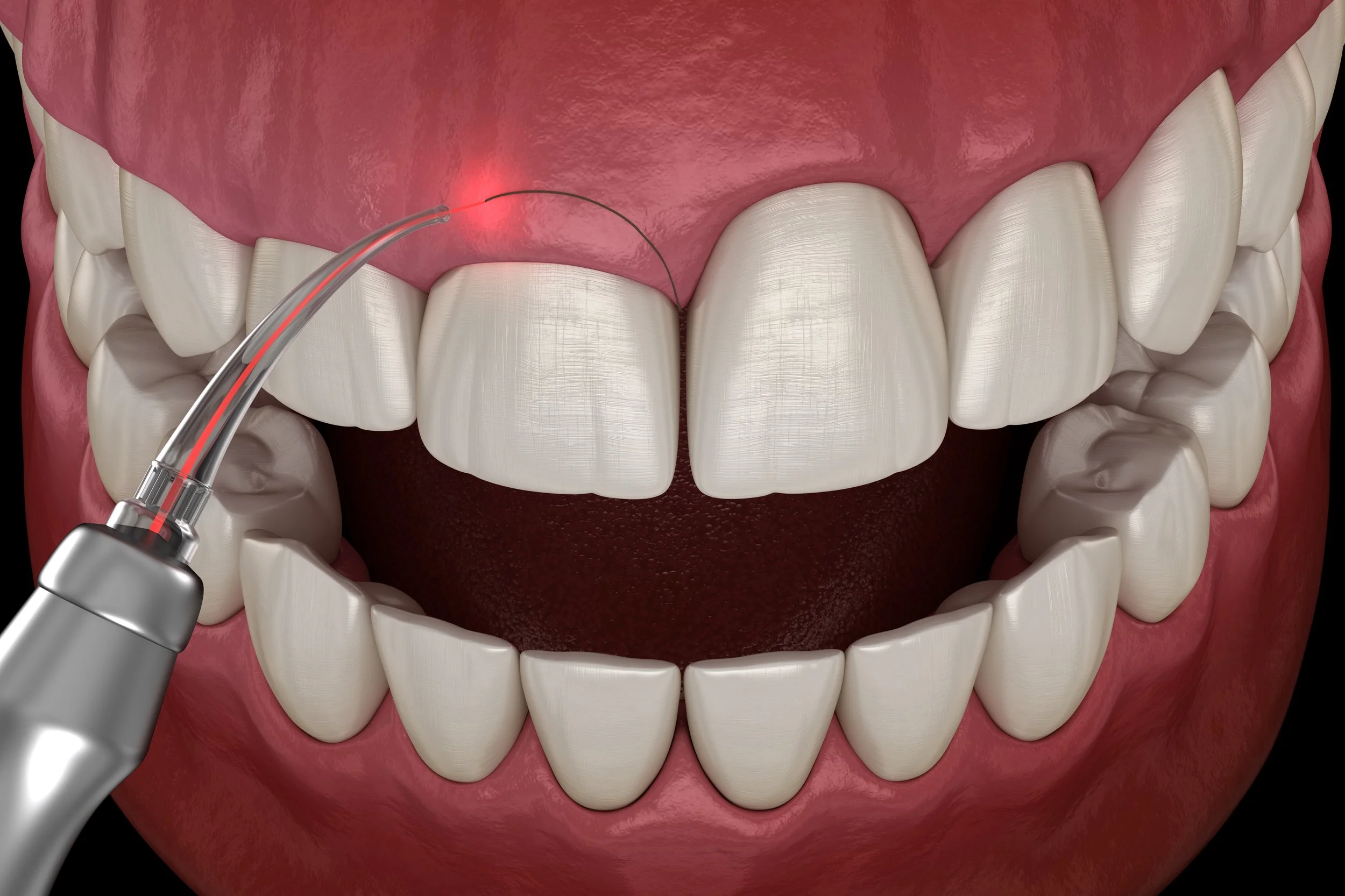 Crown Lengthening Mt. Pleasant; Periodontal Surgery Mt. Pleasant; Gum Grafting Mt. Pleasant ; Mt. Pleasant Periodontics; Dentist Mt. Pleasant; Dental Care Mt. Pleasant; Dr. Amanda Morris; Mt. Pleasant Dentistry