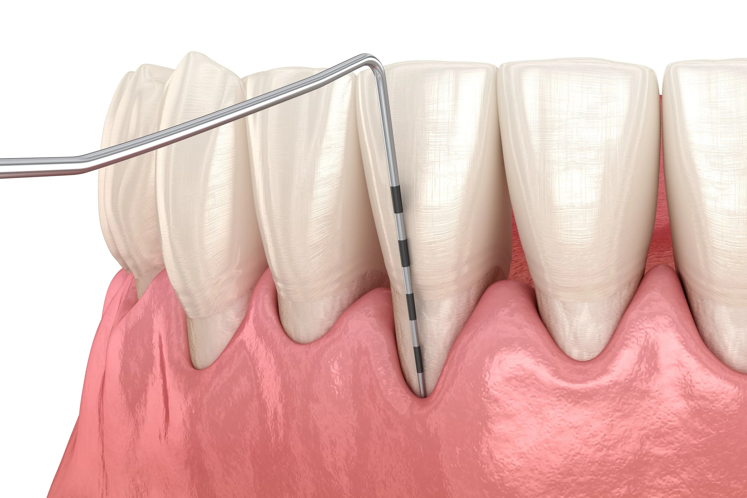 Periodontal Surgery Mt. Pleasant; Gum Grafting Mt. Pleasant ; Mt. Pleasant Periodontics; Dentist Mt. Pleasant; Dental Care Mt. Pleasant; Dr. Amanda Morris; Mt. Pleasant Dentistry