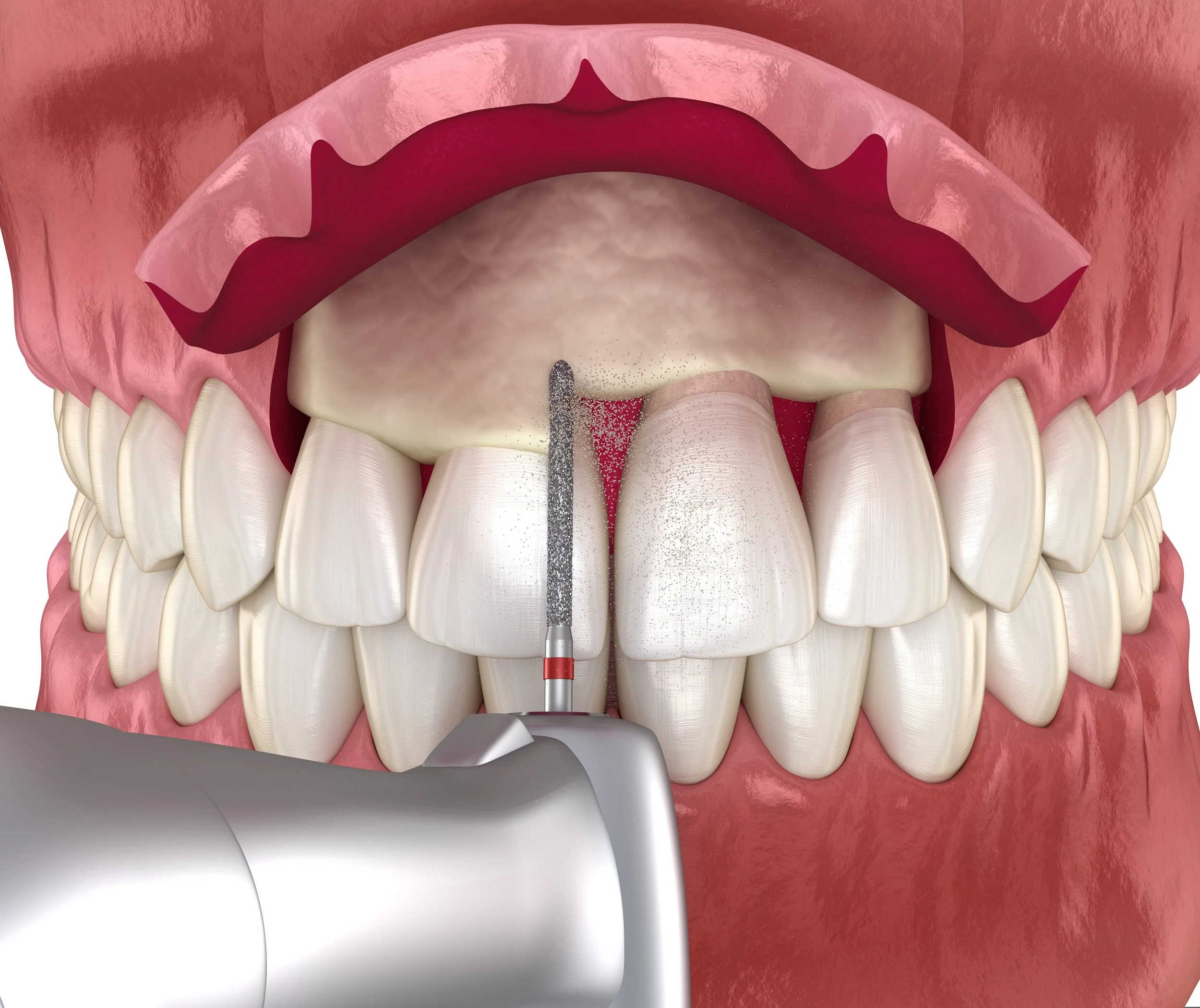 Crown Lengthening Mt. Pleasant; Periodontal Surgery Mt. Pleasant; Gum Grafting Mt. Pleasant ; Mt. Pleasant Periodontics; Dentist Mt. Pleasant; Dental Care Mt. Pleasant; Dr. Amanda Morris; Mt. Pleasant Dentistry