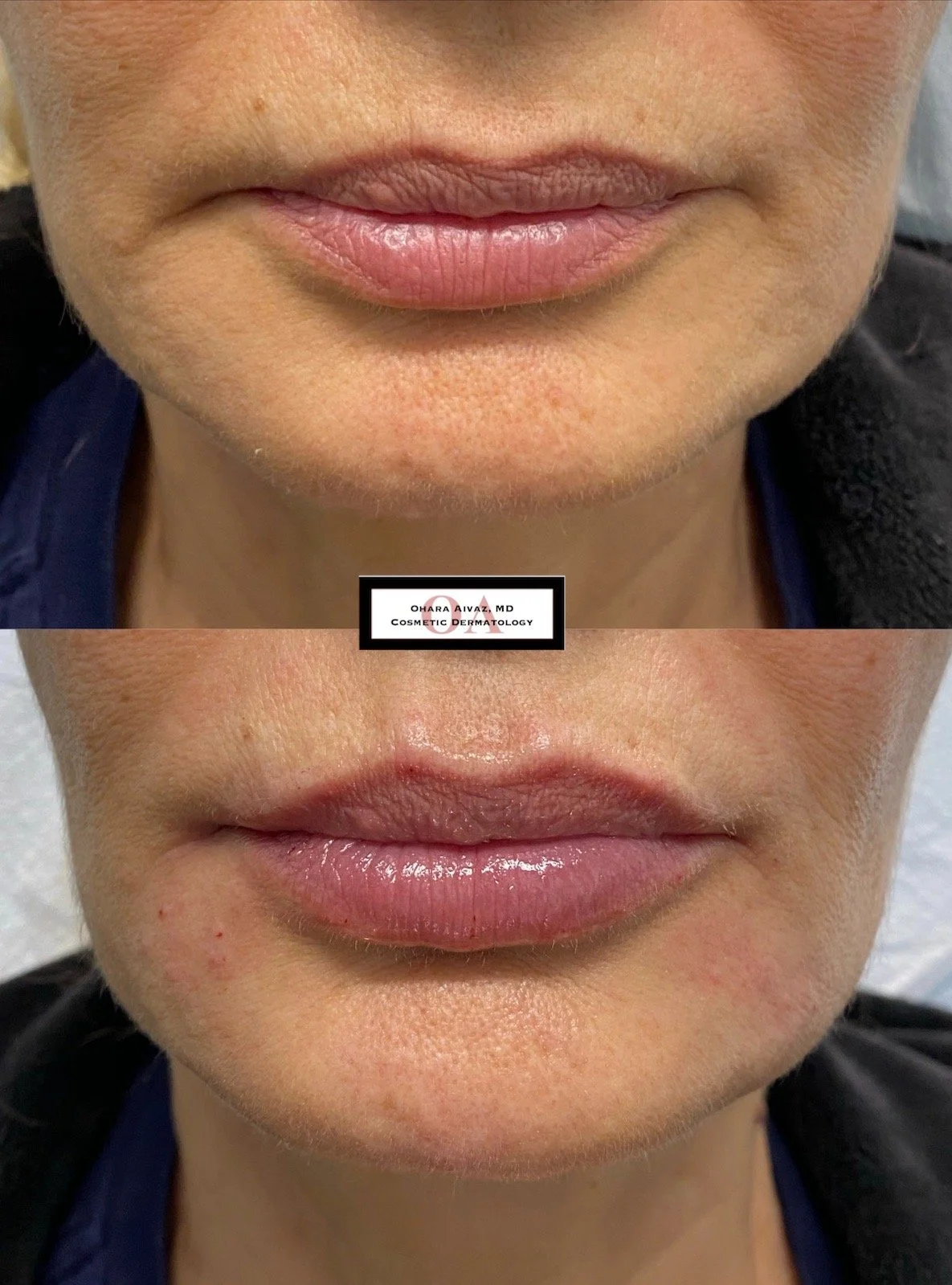 restylane juvederm filler