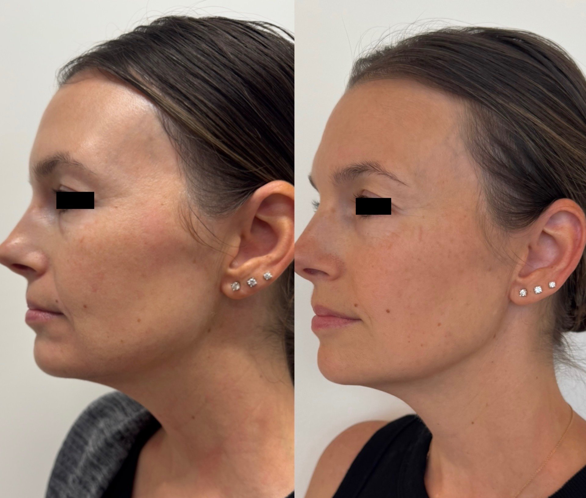 Before and after comparison of a person’s eye area following cosmetic neurotoxin treatment, showing reduced appearance of wrinkles, performed by Dr. Ohara Aivaz, MD.