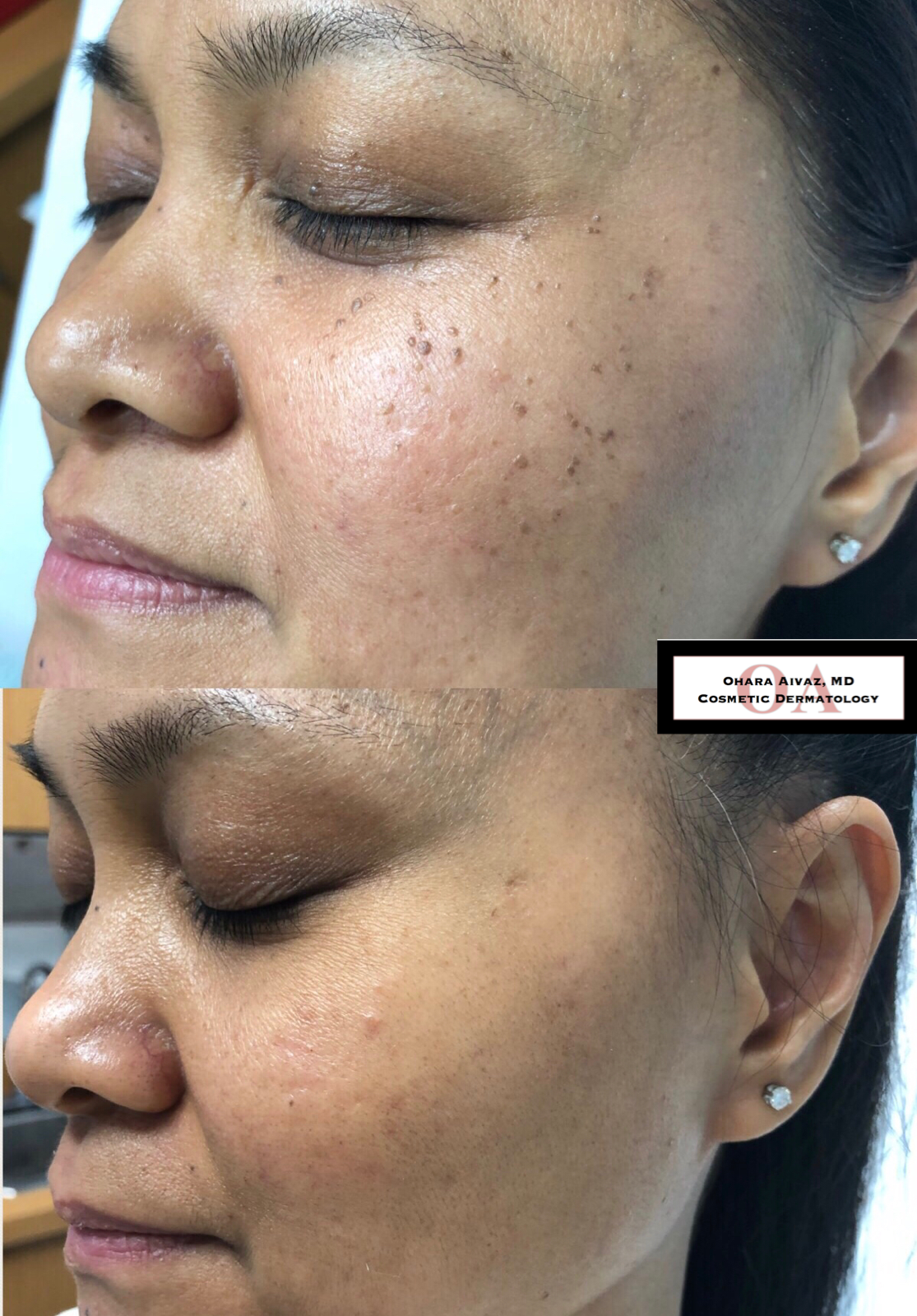 Close-up comparison of a woman's face before and after skincare treatment, illustrating significant reduction in dark spots, hyperpigmentation, and uneven skin texture on her cheek, with her eyes closed in both images.