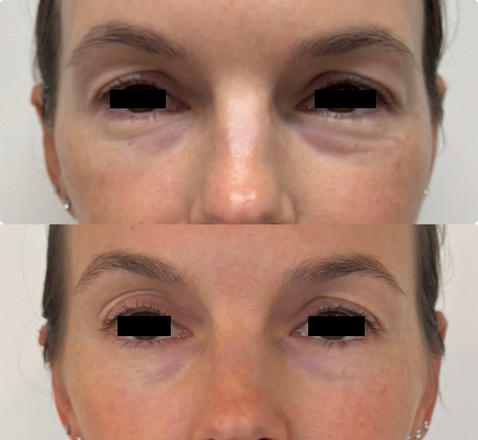 Before and after comparison of a person’s forehead following cosmetic neurotoxin injections, showing reduced appearance of forehead wrinkles.