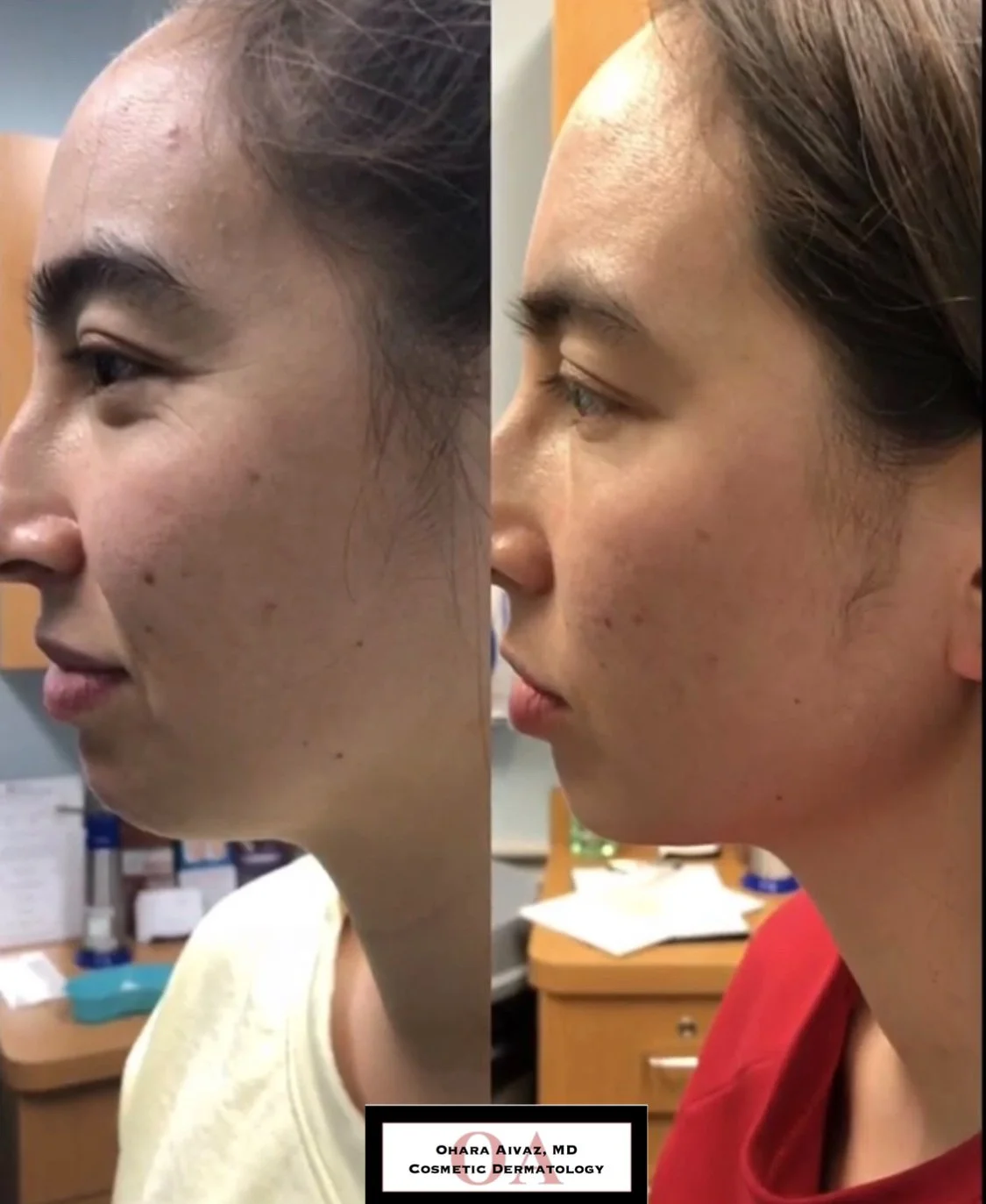 Side-by-side before and after comparison of a woman’s face following Kybella treatment for double chin reduction and jawline enhancement, showing improved skin texture and reduced pigmentation.