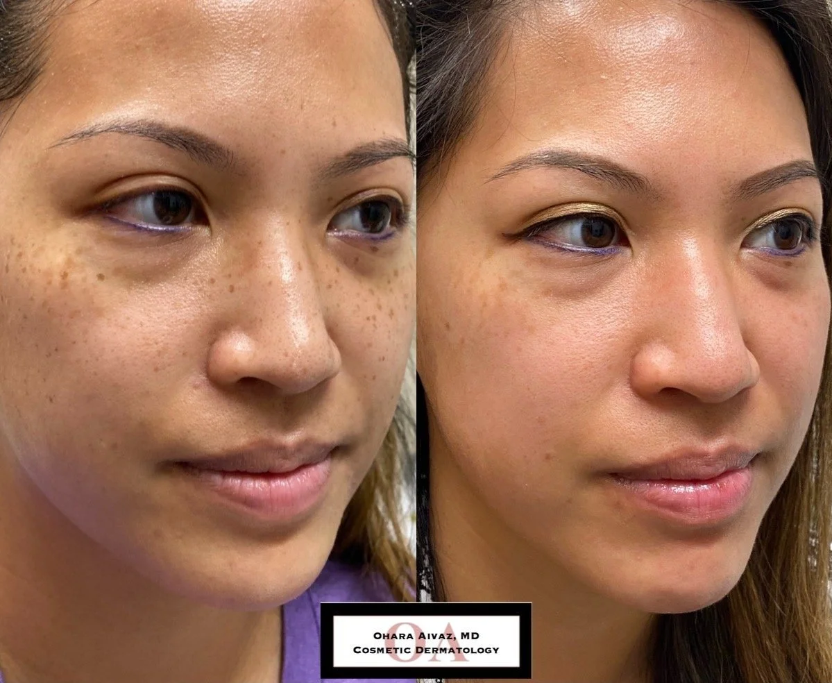 A side-by-side comparison of a woman’s face before and after skin treatment, showing improved skin clarity and texture. The before image on the left displays freckles and uneven skin tone, while the after image on the right shows smoother, clearer skin with a more even tone. 
