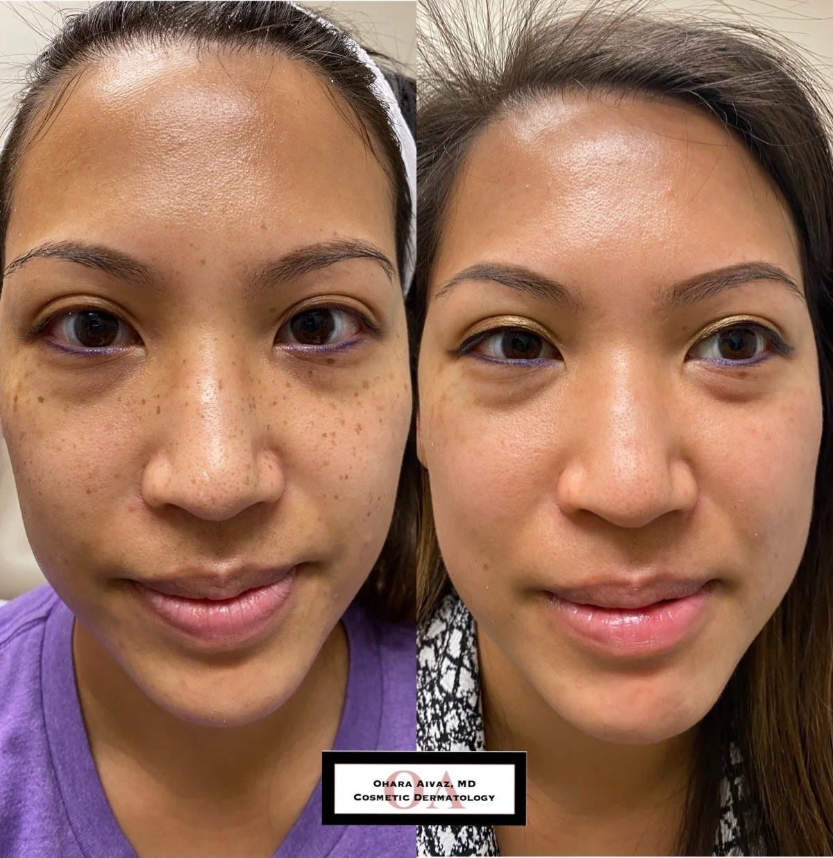 Pigmentation and Freckle Removal Before and After Photo Gallery — Dr
