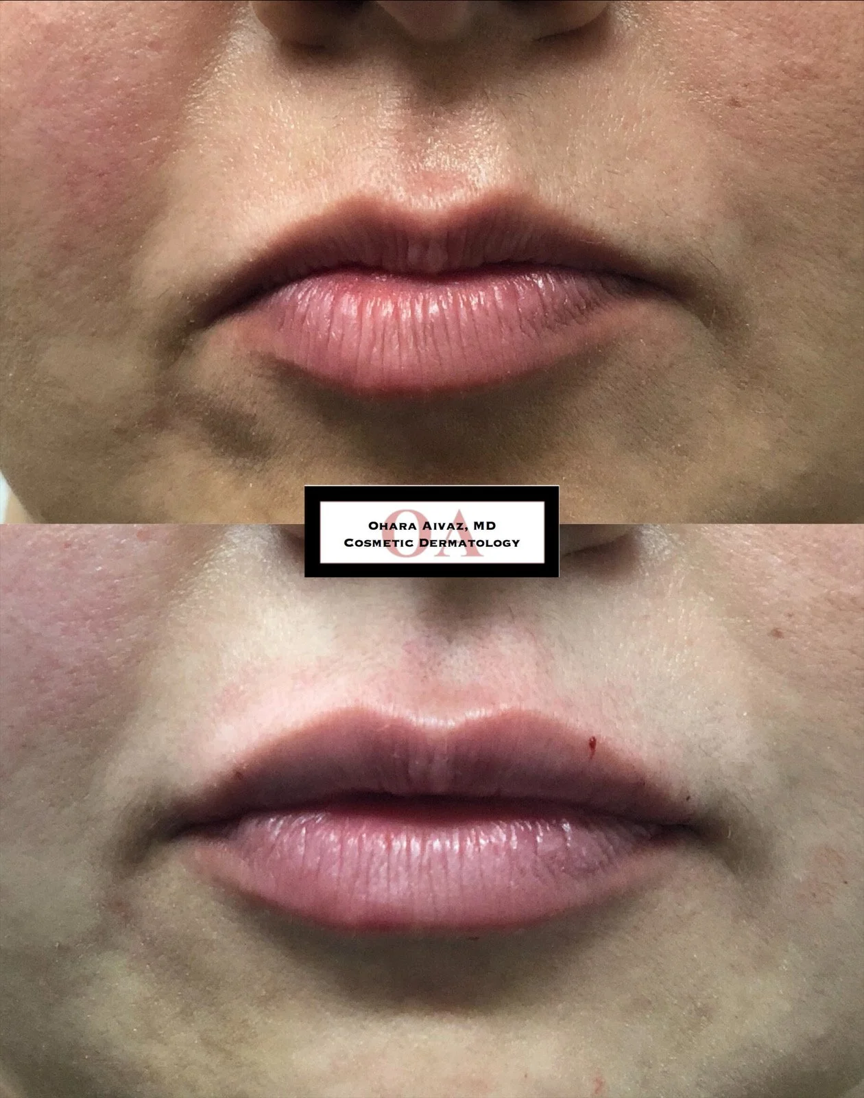 Close-up before and after comparison of a woman’s lips following cosmetic lip filler treatment performed by Dr. Ohara Aivaz, board-certified dermatologist.