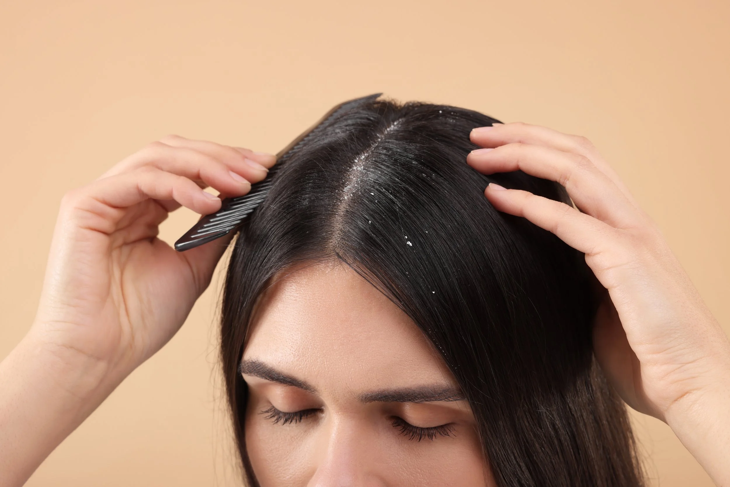 Dandruff or Dry Scalp? How to Tell the Difference