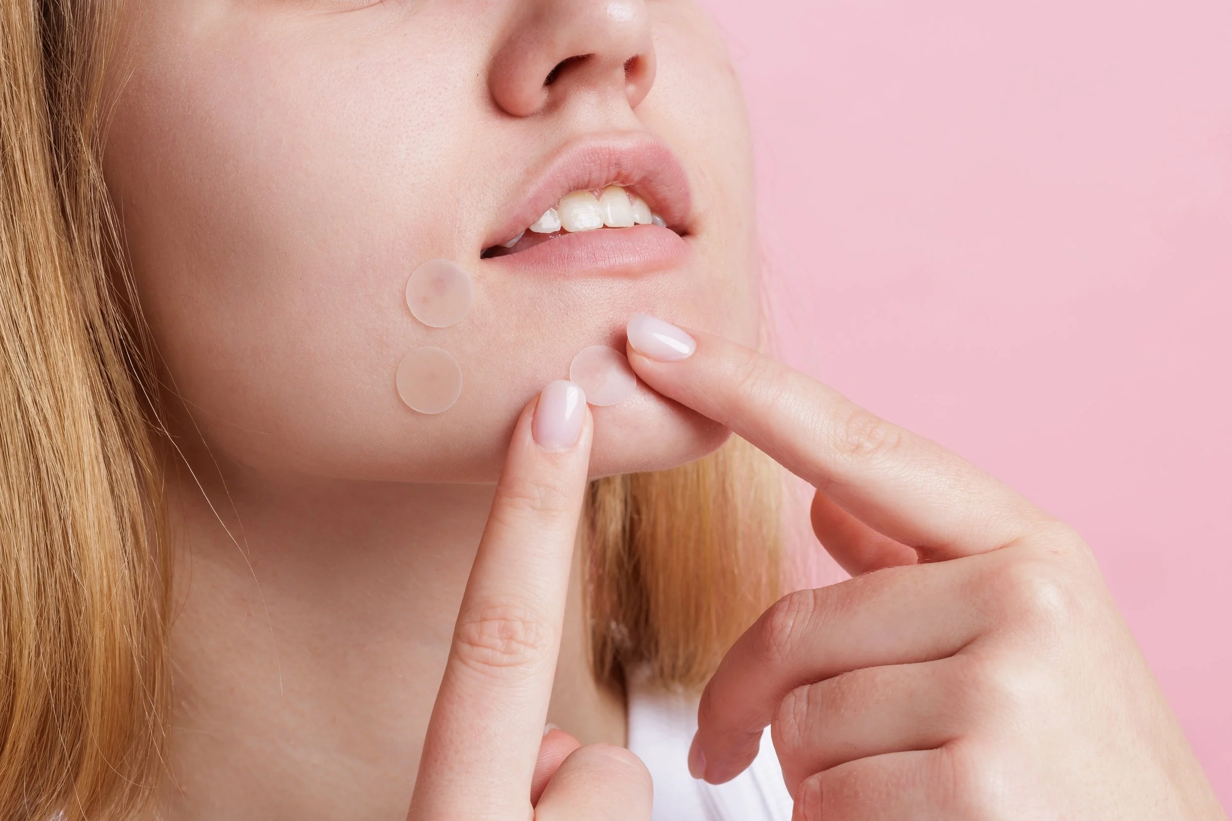 How to Fade Acne Scars Fast