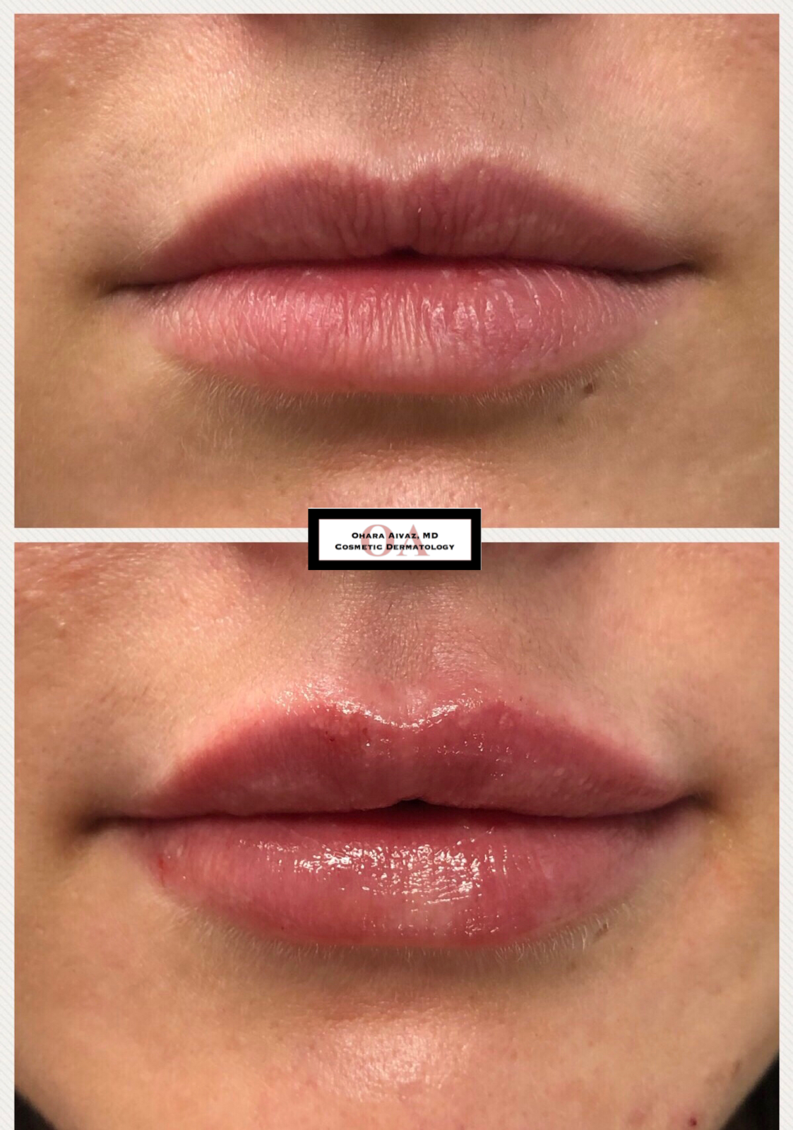 Close-up before and after comparison of a woman’s lips following cosmetic lip filler treatment performed by Dr. Ohara Aivaz, board-certified dermatologist.