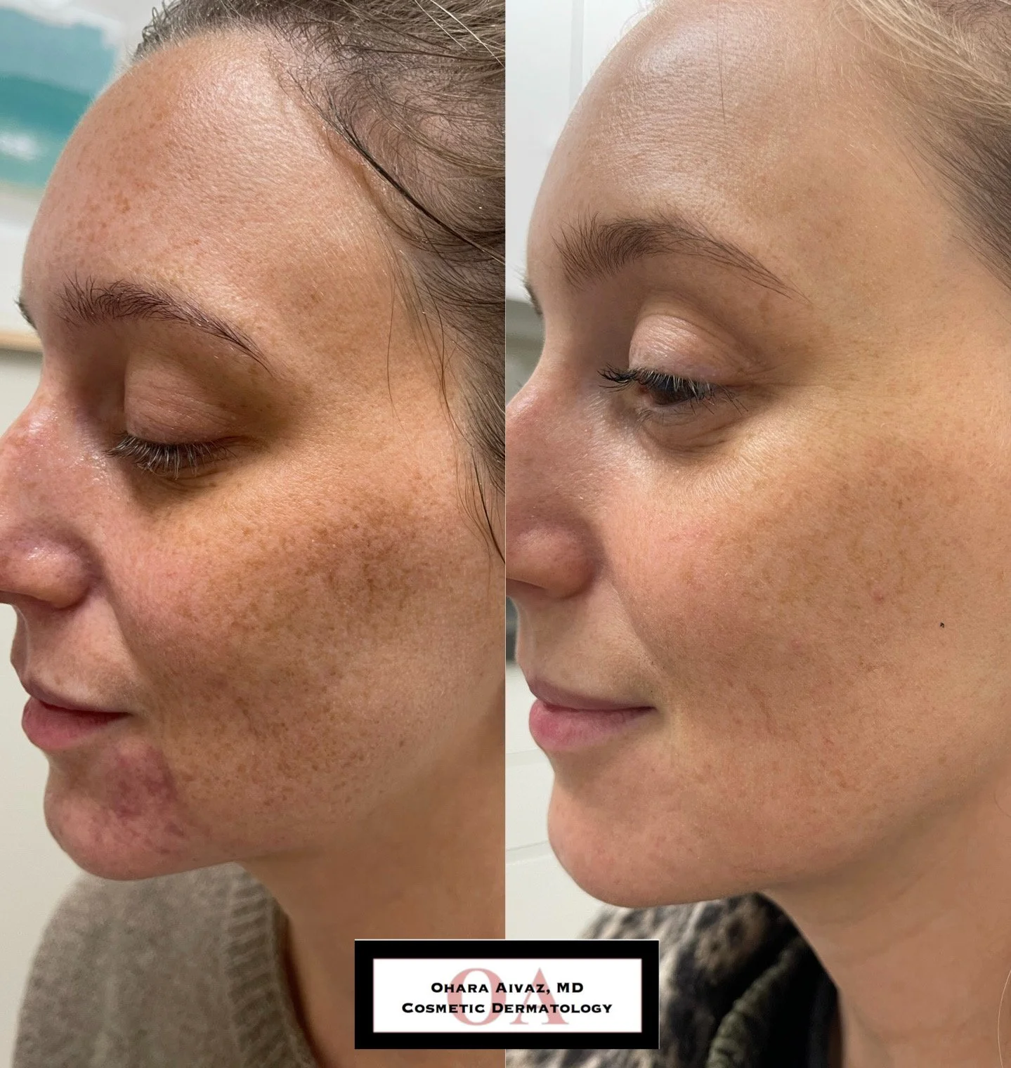 Side-by-side comparison of a woman's face before and after dermatological treatment. The left shows significant redness, freckles, and skin texture issues. The right shows clearer, smoother skin with reduced redness and freckles.