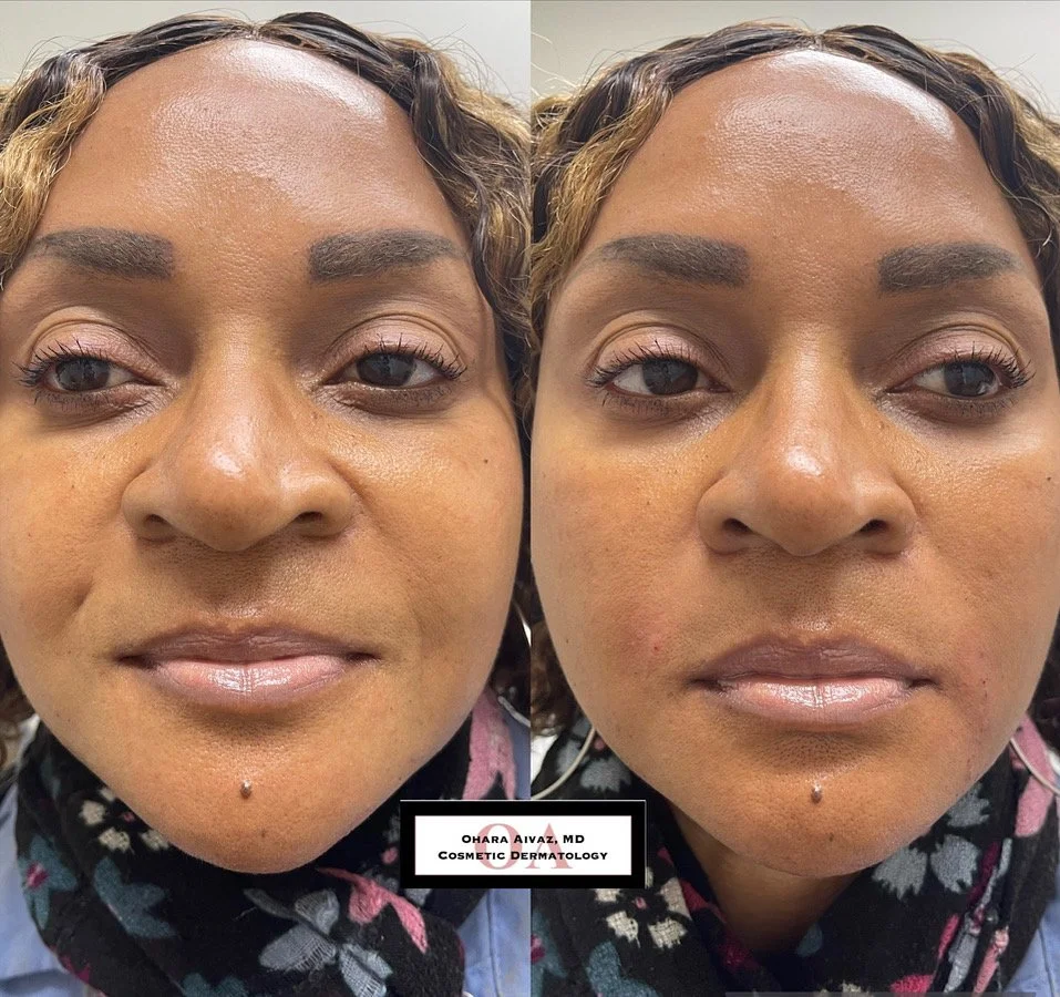 restylane juvederm filler