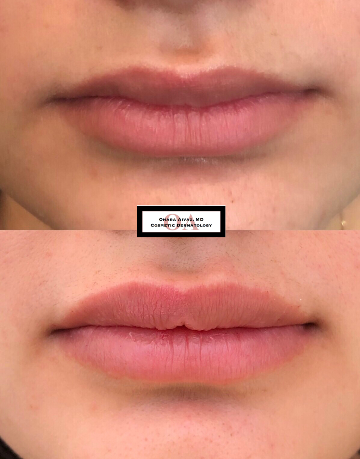 Close-up before and after comparison of a woman’s lips following cosmetic lip filler treatment performed by Dr. Ohara Aivaz, board-certified dermatologist.