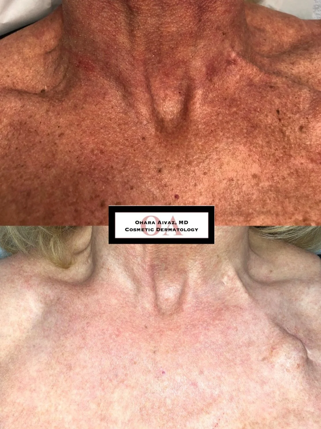 Before and after comparison of a patient’s chest following IPL treatment for sun damage, pigmentation, and broken capillaries, showing improved skin texture and reduced redness.
