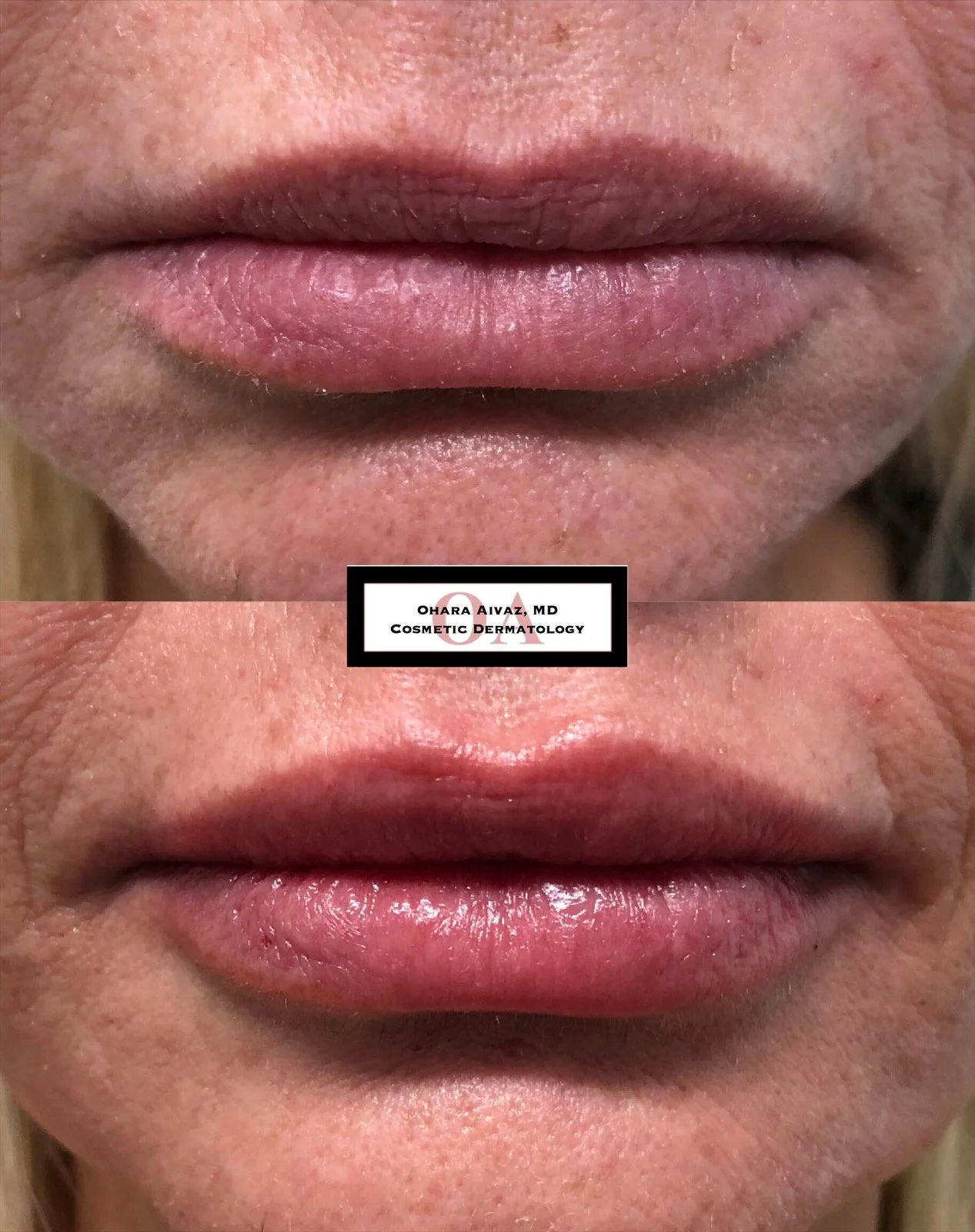 Close-up before and after comparison of a woman’s lips following cosmetic lip filler treatment performed by Dr. Ohara Aivaz, board-certified dermatologist.