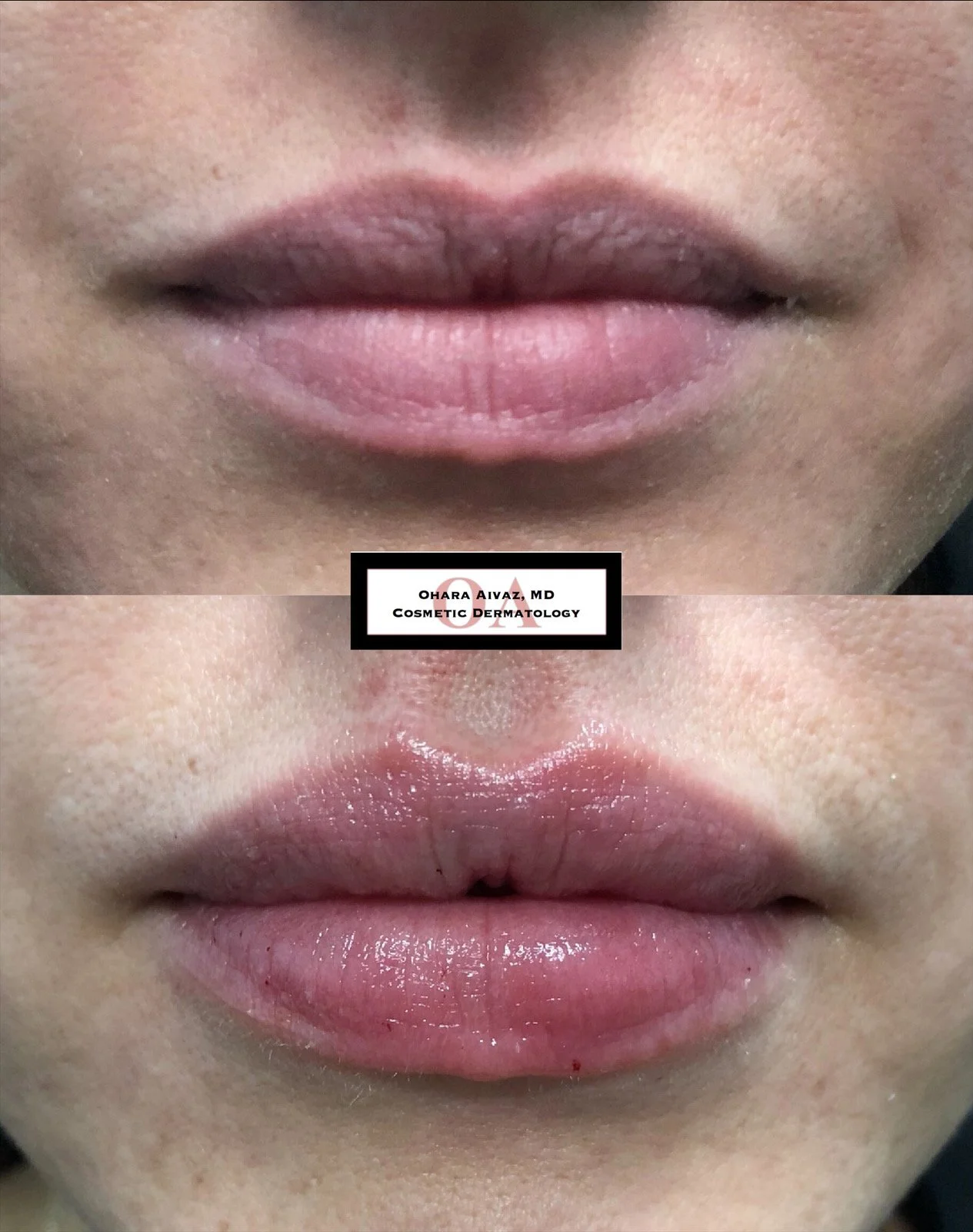 Close-up before and after comparison of a woman’s lips following cosmetic lip filler treatment, with Dr. Ohara Aivaz, MD Cosmetic Dermatology.