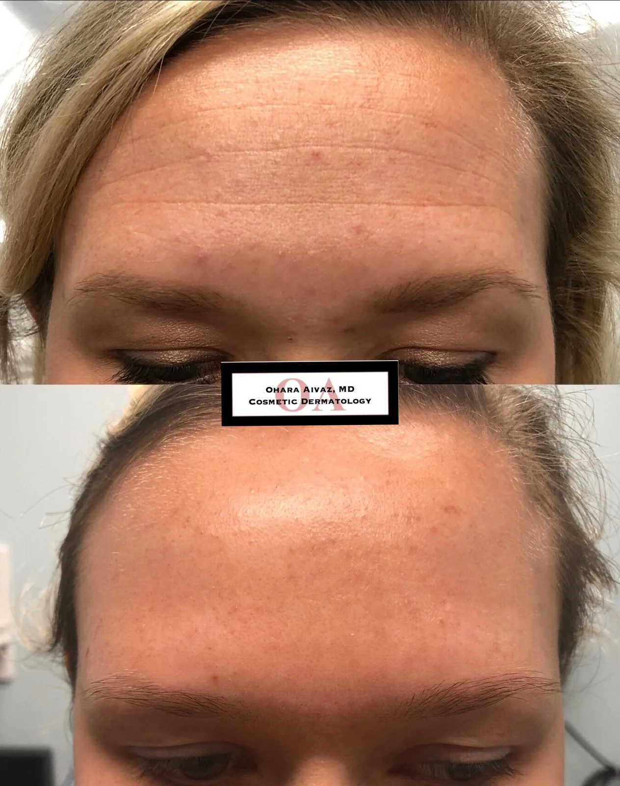 Before and after comparison of a person’s forehead following cosmetic neurotoxin injections, showing reduced appearance of forehead wrinkles.