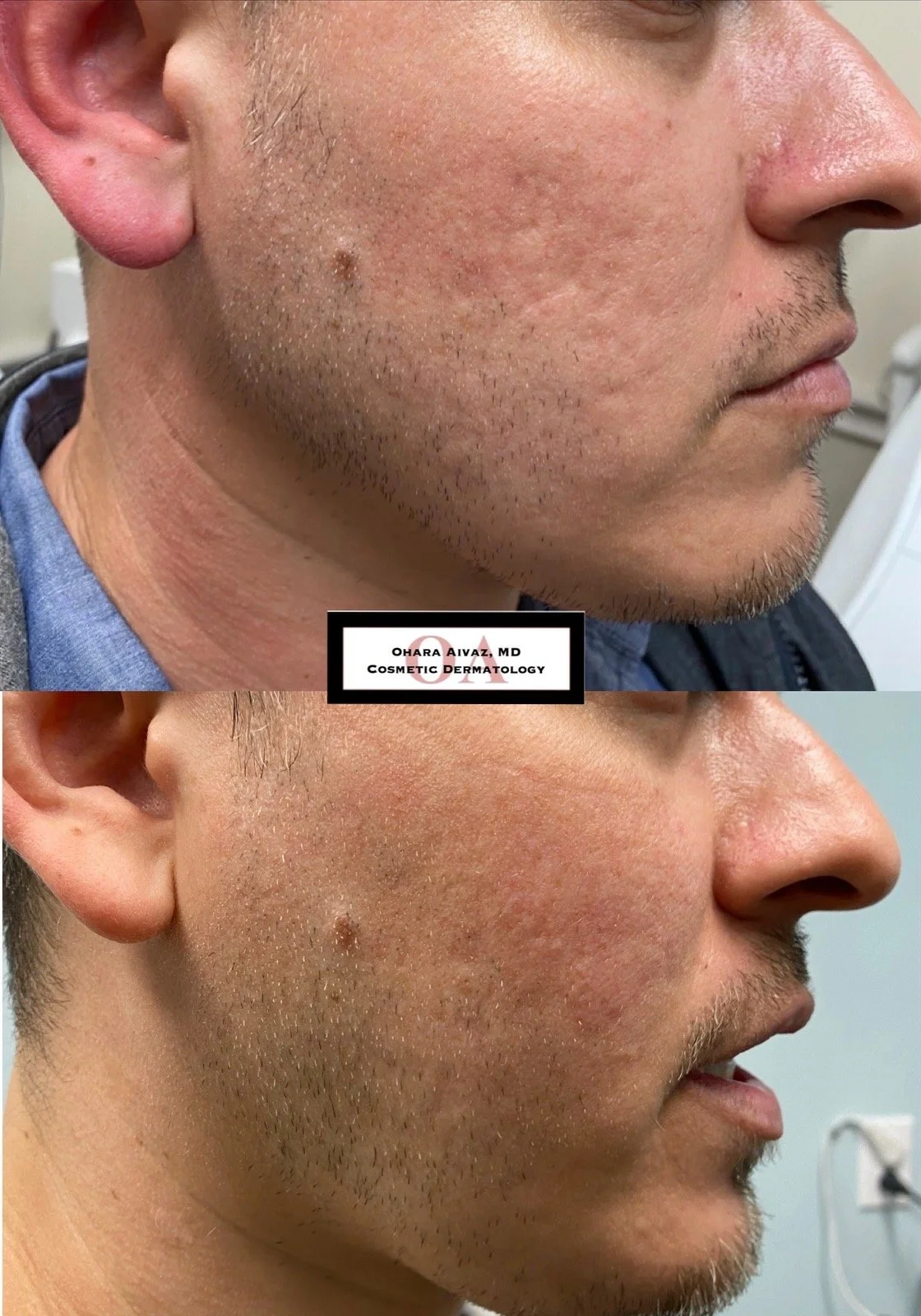 Before and after comparison of a man’s lower face following radiofrequency microneedling and dermal filler treatment for acne scarring, showing smoother skin texture and reduced pore appearance.