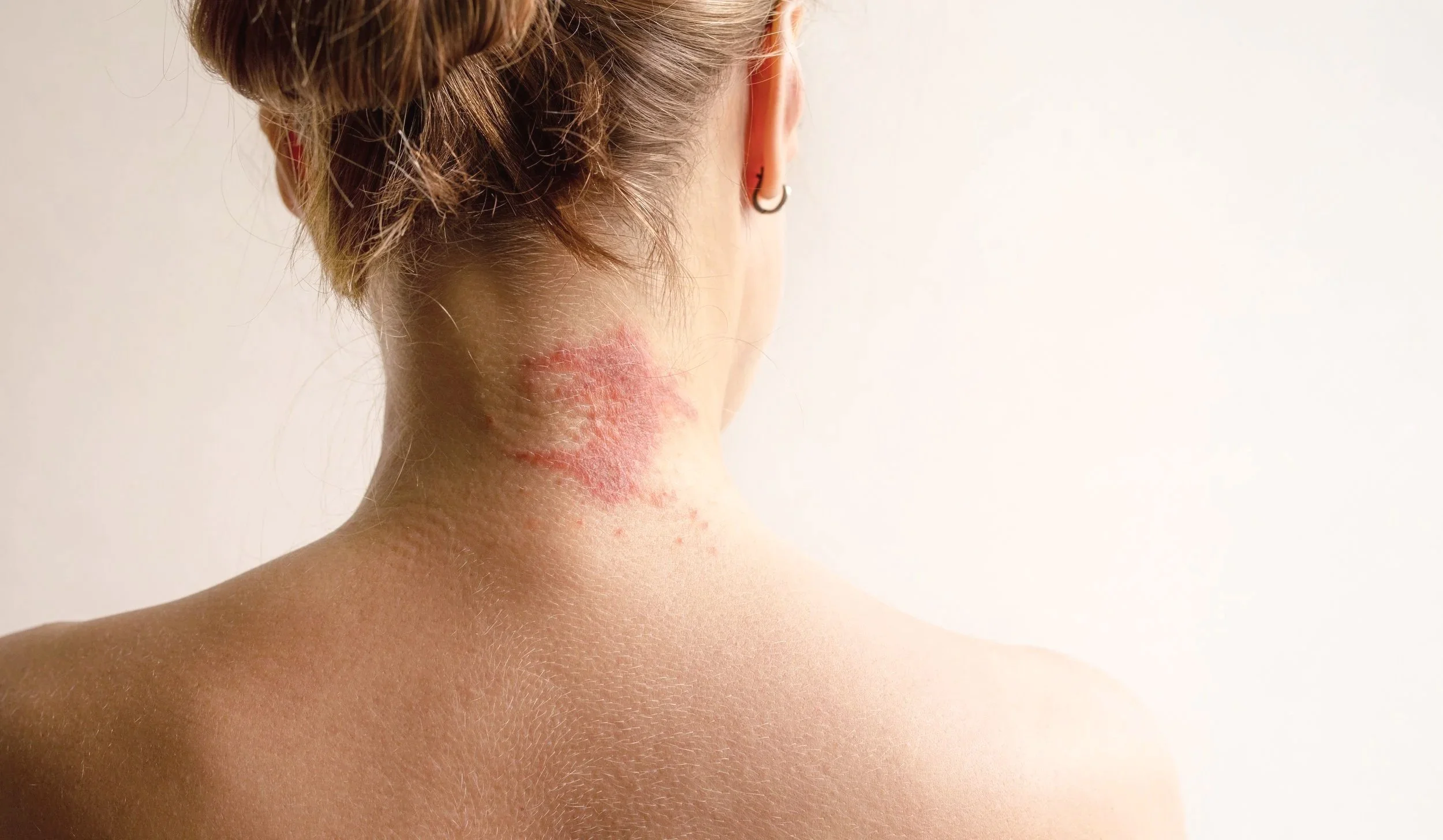 Back of a woman’s neck showing red, irritated, and dry skin associated with eczema before dermatologic treatment.