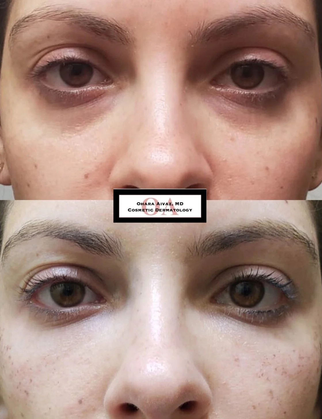 Before and after comparison of a woman’s face following under-eye dermal filler treatment, showing improved skin clarity and reduced facial redness across the forehead, cheeks, and eye area.