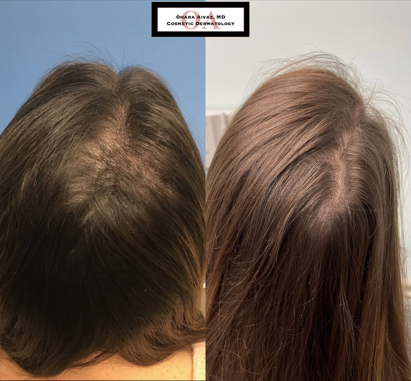 Comparison of a woman's scalp showing hair thinning on the left and thicker hair on the right after treatment.