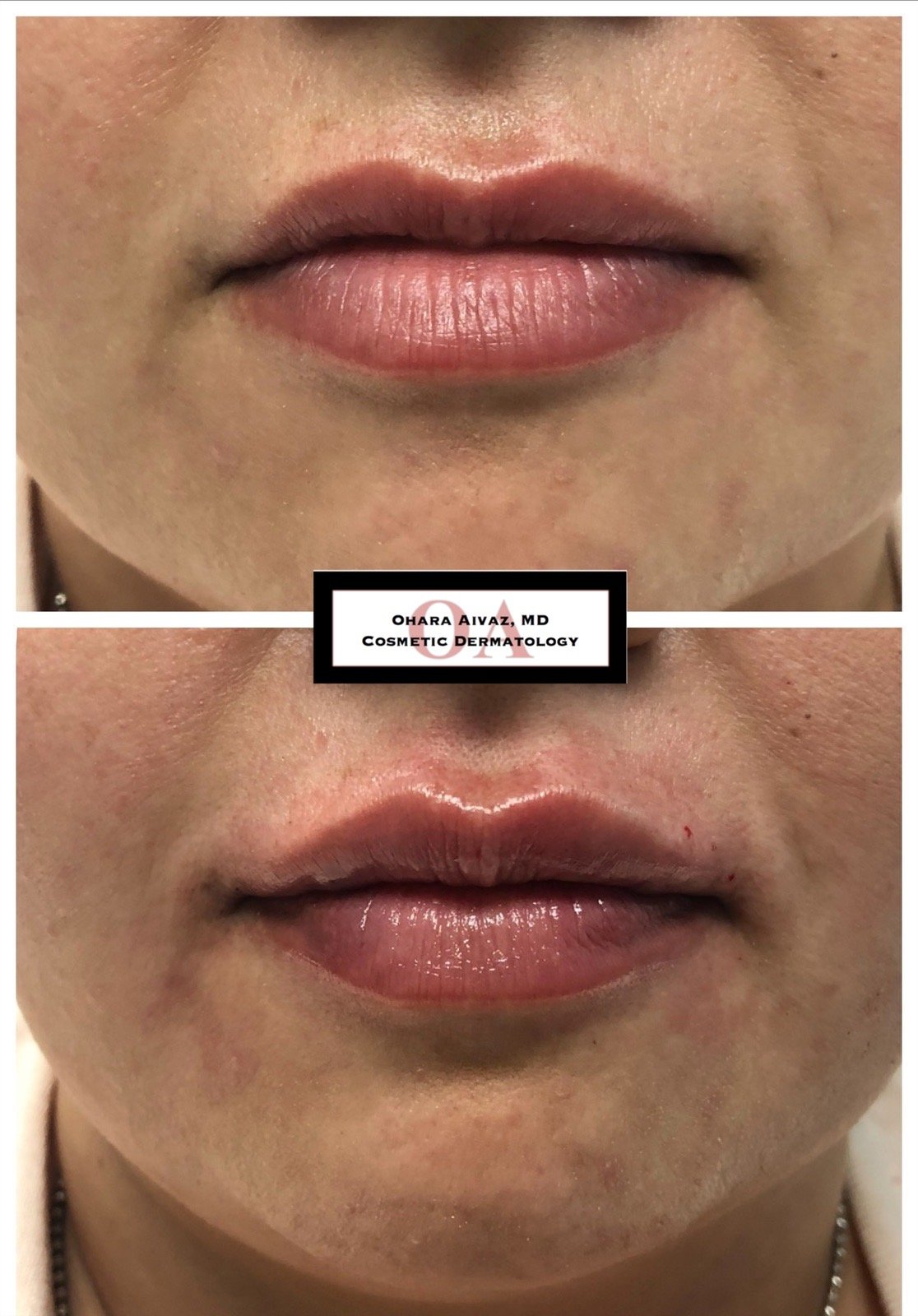 restylane juvederm filler