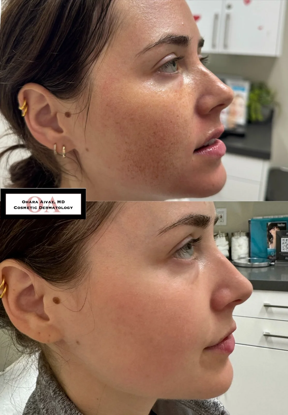 Before and after comparison of a woman’s face following a single IPL treatment to reduce freckles and pigmentation, showing improved skin tone and texture.