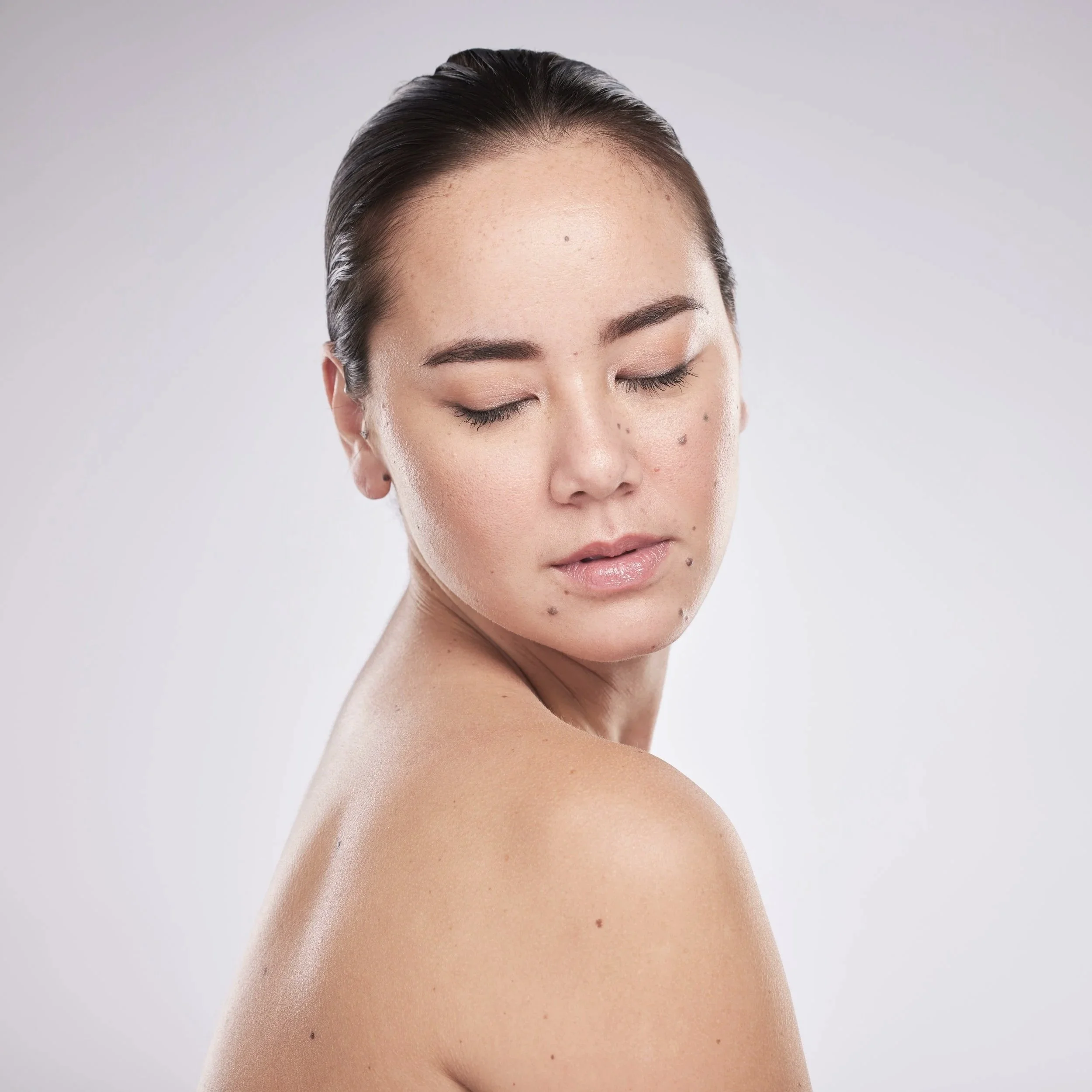 Close-up of a woman’s face showing a brown mole prior to dermatologic evaluation and removal.