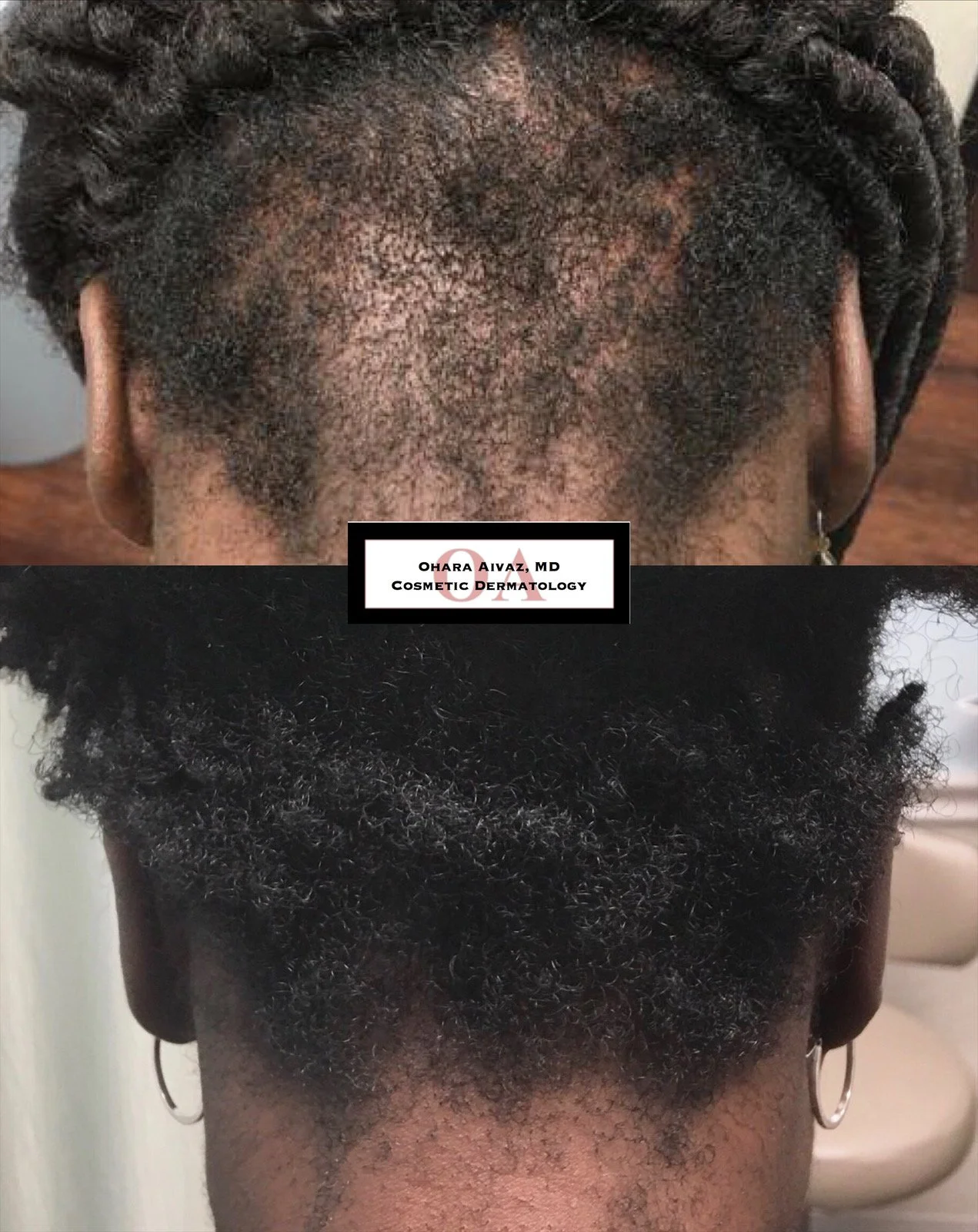 Comparison of a person's scalp before and after hair treatment, showing significant hair regrowth and thickening after treatment.
