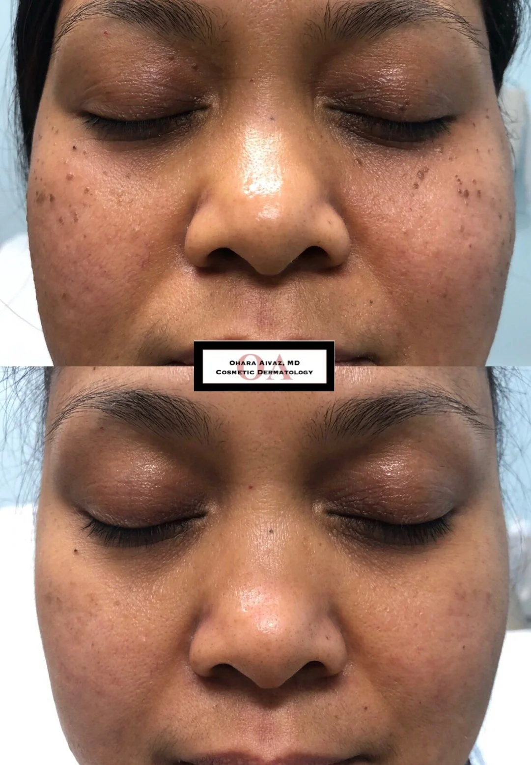 Before and after comparison of a woman's face before and after facial treatment, showing reduced hyperpigmentation and clearer skin.