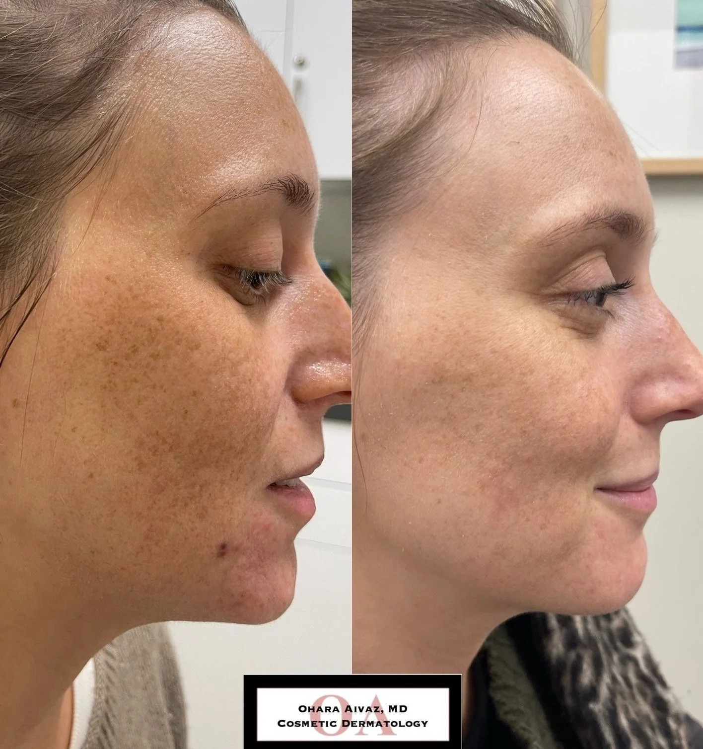 Side-by-side comparison of a woman's face before and after dermatological treatment. The left shows significant redness, freckles, and skin texture issues. The right shows clearer, smoother skin with reduced redness and freckles.