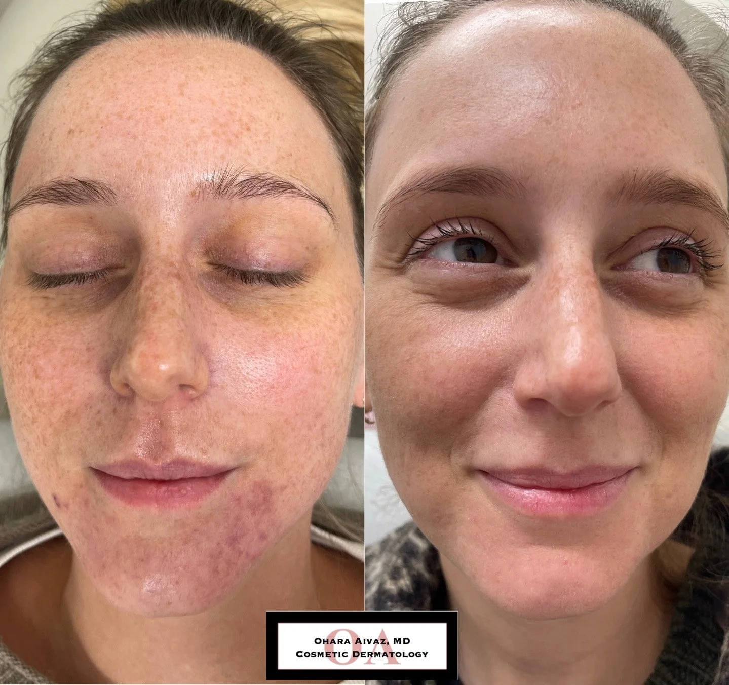 Before and after close-up images of a woman's face showing skin improvement, with reduced freckles and spots after cosmetic dermatology treatment by Dr. Ohara Aivaz.