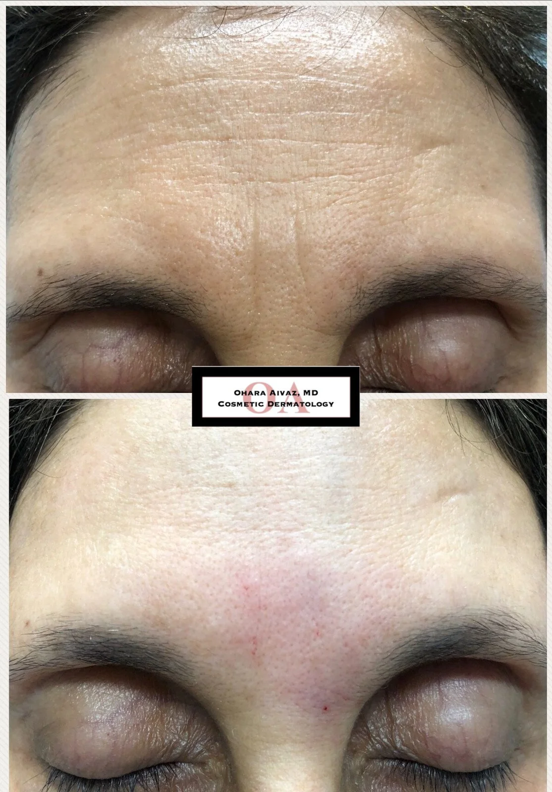 Before and after comparison of a person’s forehead following cosmetic neurotoxin injections, showing reduced appearance of forehead wrinkles.