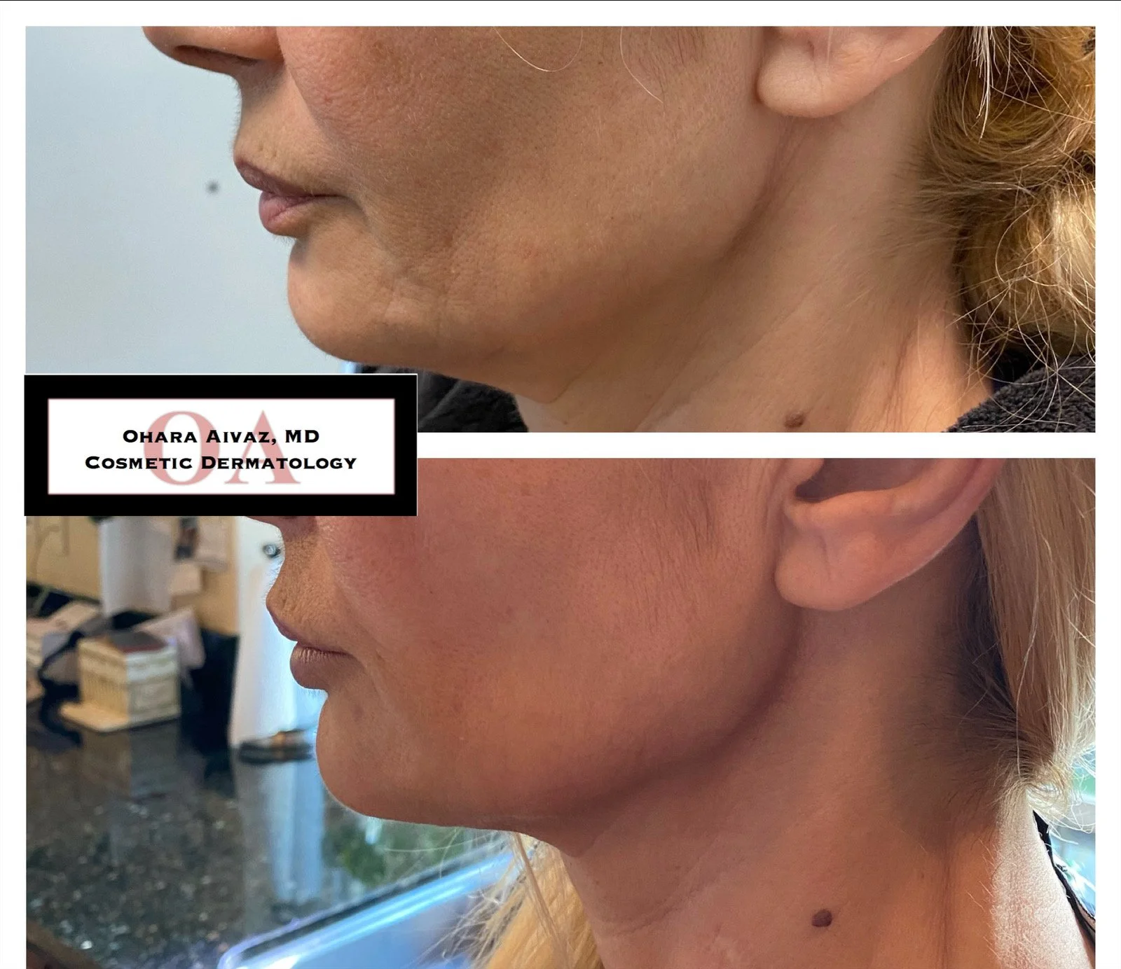 Before and after side-profile comparison of a woman’s face following a non-surgical Nefertiti Lift using Botox to tighten and define the jawline.