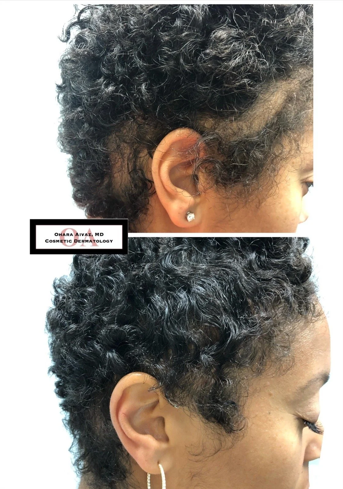 Before and after images of a woman with short, curly hair showing scalp treatment results.