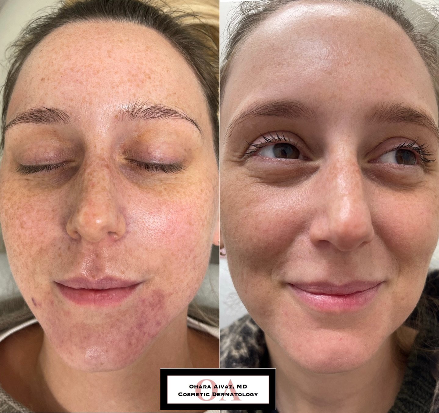 Side-by-side comparison of a woman's face before and after dermatological treatment. The left shows significant redness, freckles, and skin texture issues. The right shows clearer, smoother skin with reduced redness and freckles.