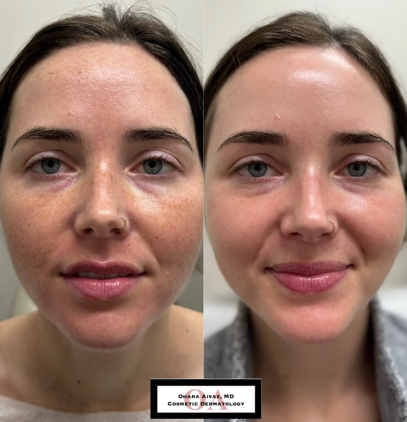 Side-by-side before and after comparison of a woman’s face following a single IPL treatment to reduce freckles and pigmentation, showing improved skin tone and texture.