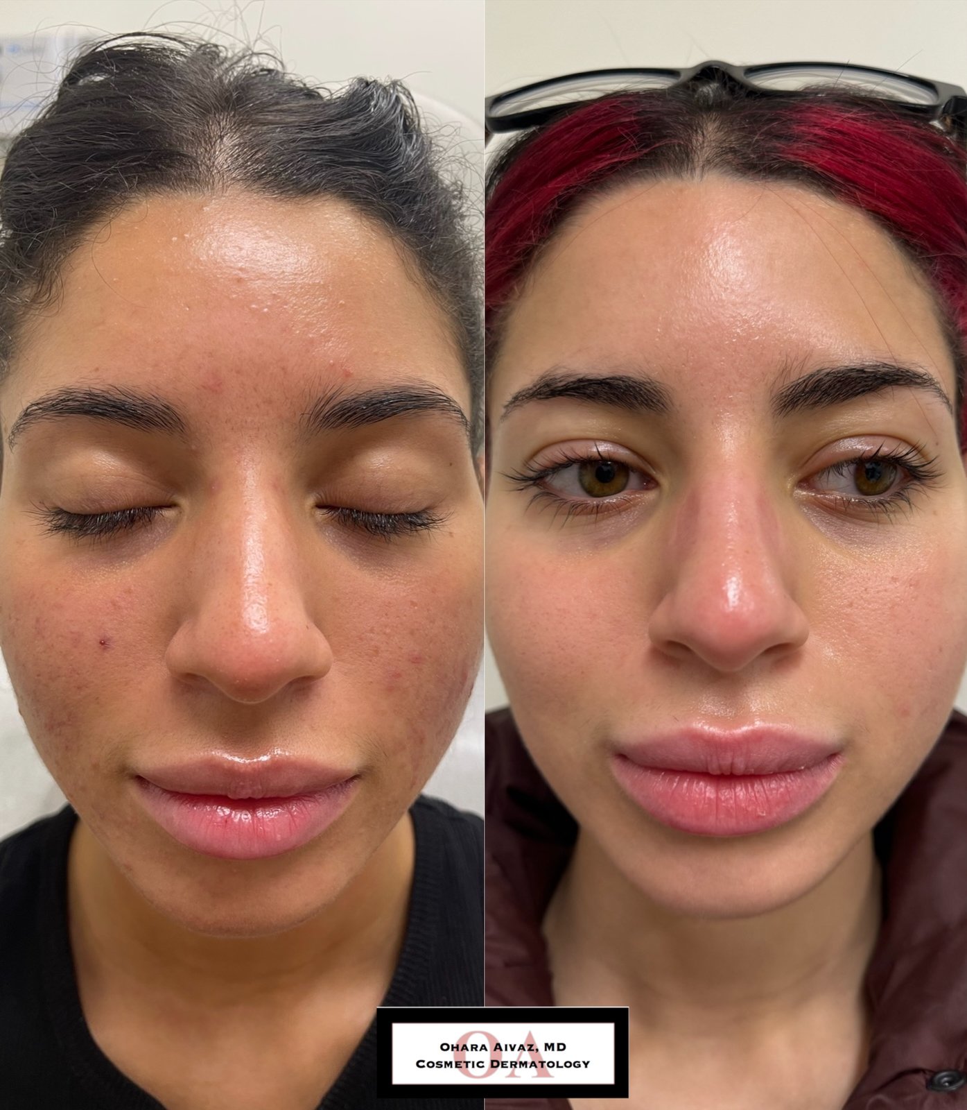 Side-profile before and after comparison of a woman’s face following a course of Accutane treatment, showing improvement in acne, redness, and overall skin clarity.