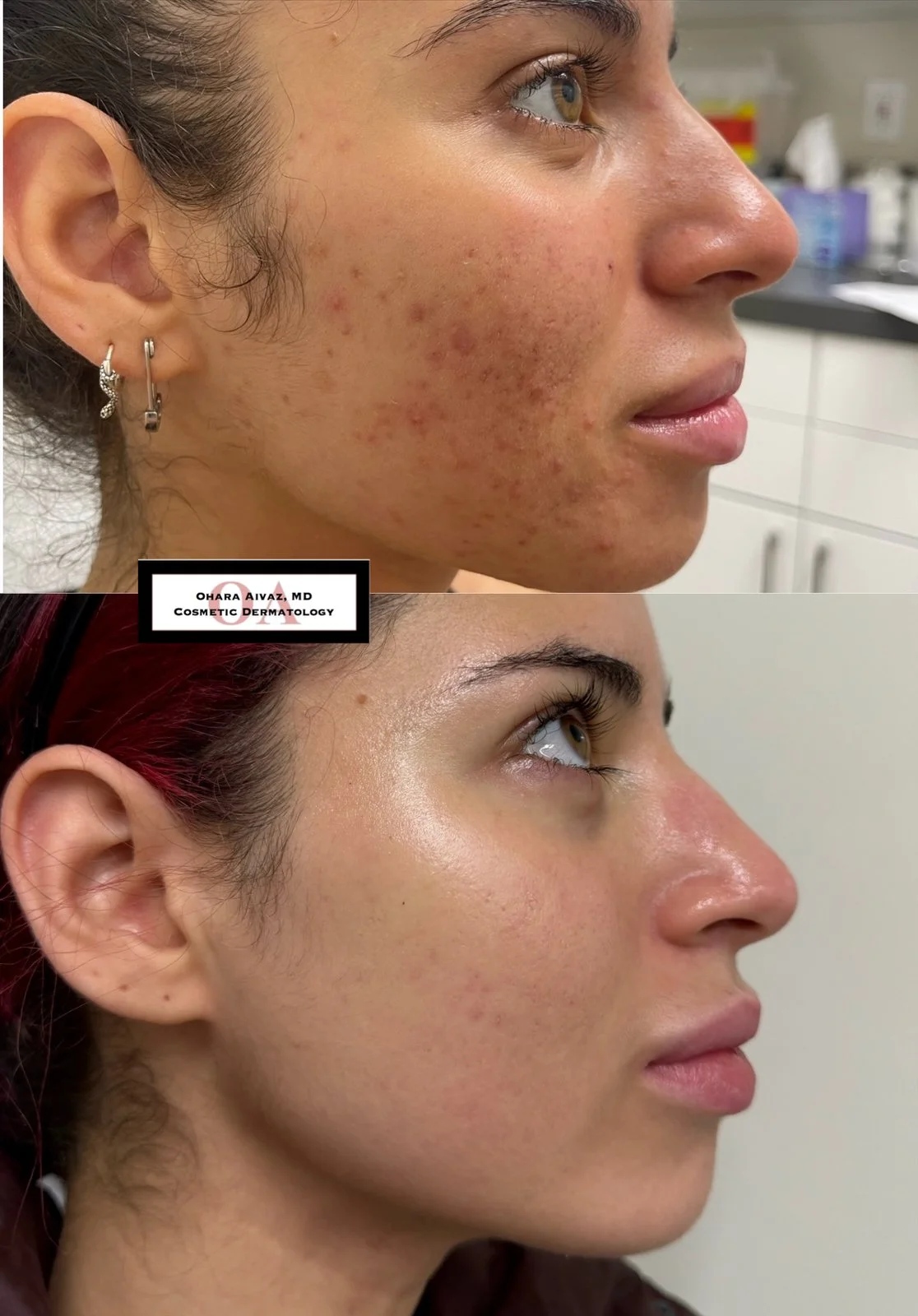 Before and after comparison of a woman’s face following a course of Accutane treatment, showing improvement in acne, redness, and overall skin clarity.