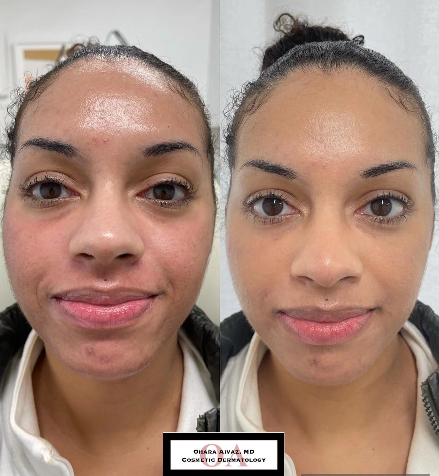restylane juvederm filler